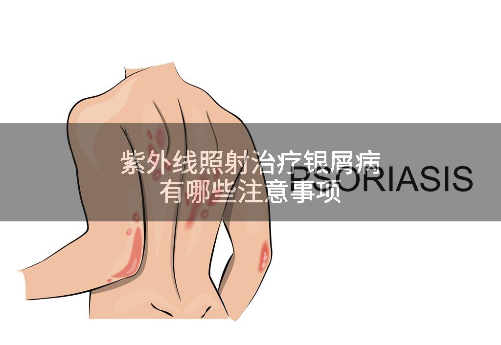 紫外线照射治疗银屑病有哪些注意事项