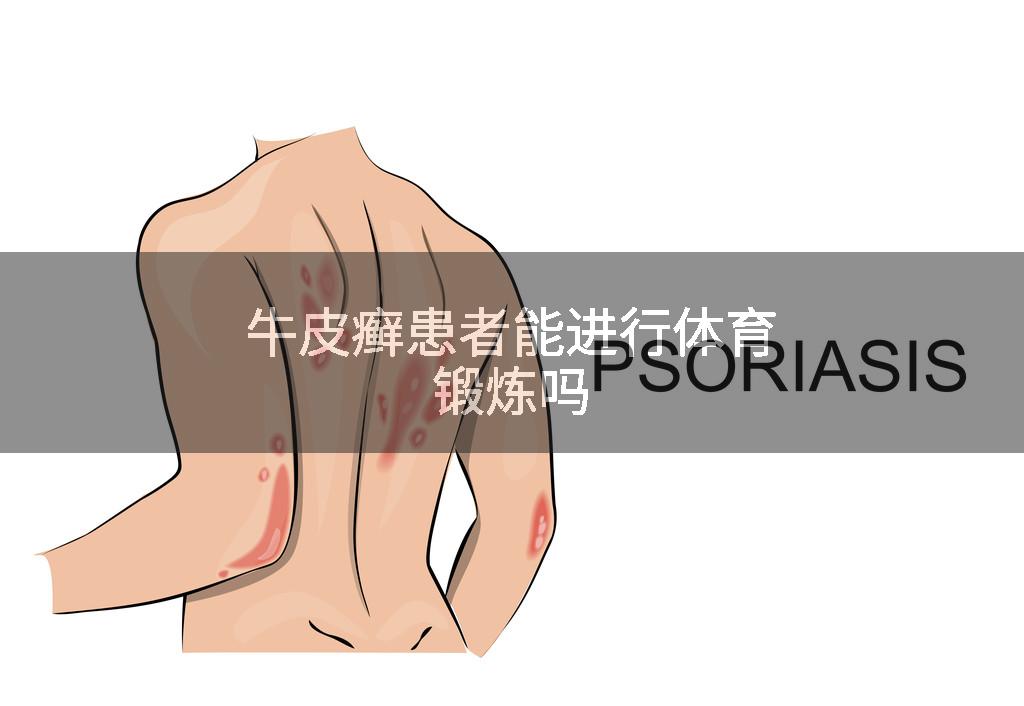 牛皮癣患者能进行体育锻炼吗