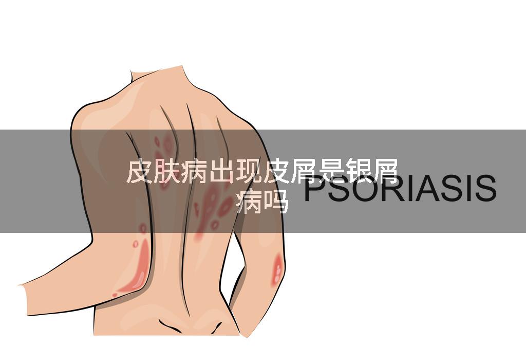 皮肤病出现皮屑是银屑病吗