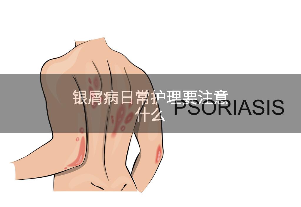 银屑病日常护理要注意什么