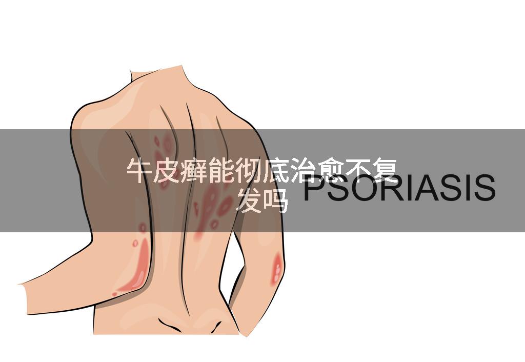 牛皮癣能彻底治愈不复发吗