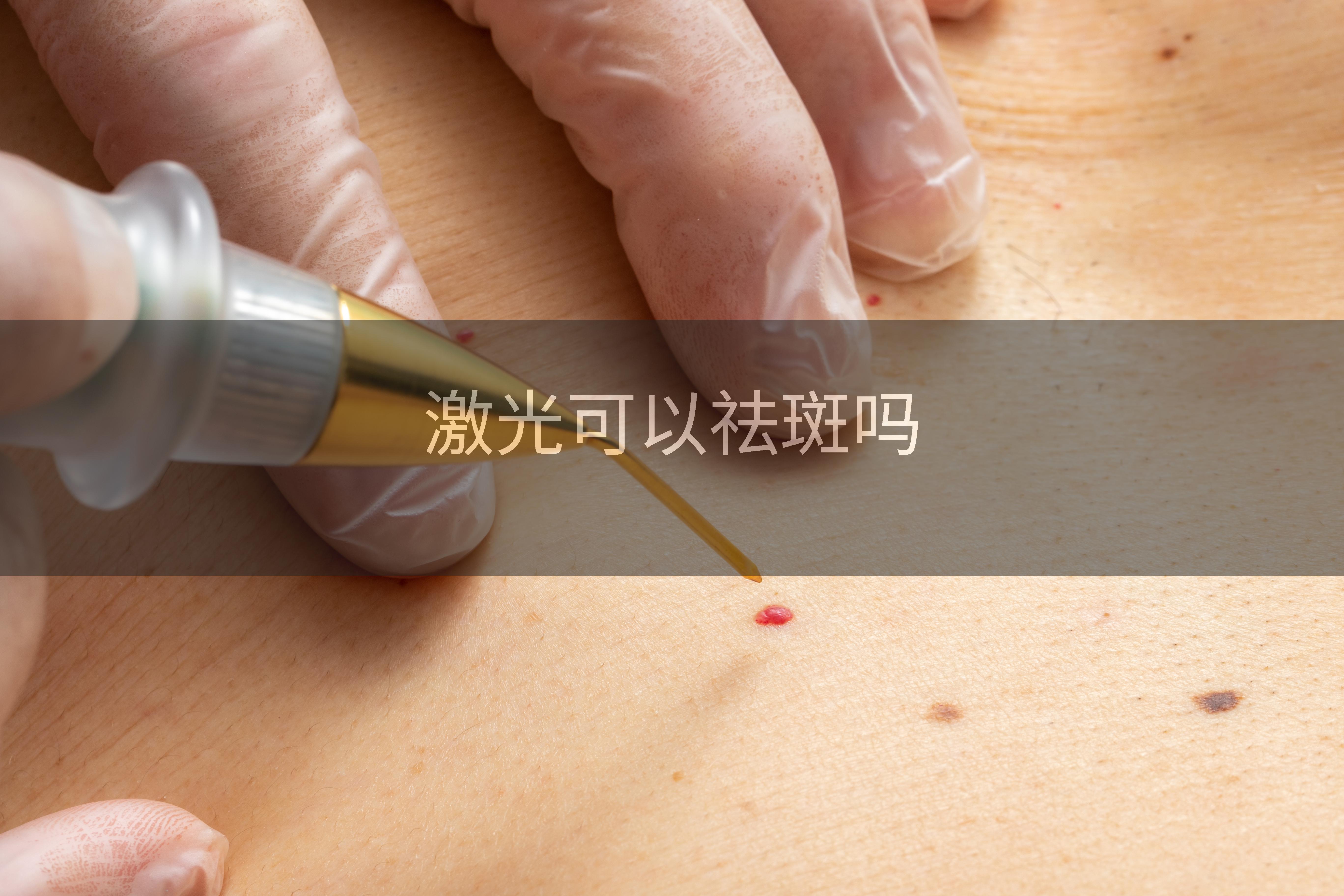 激光可以祛斑吗