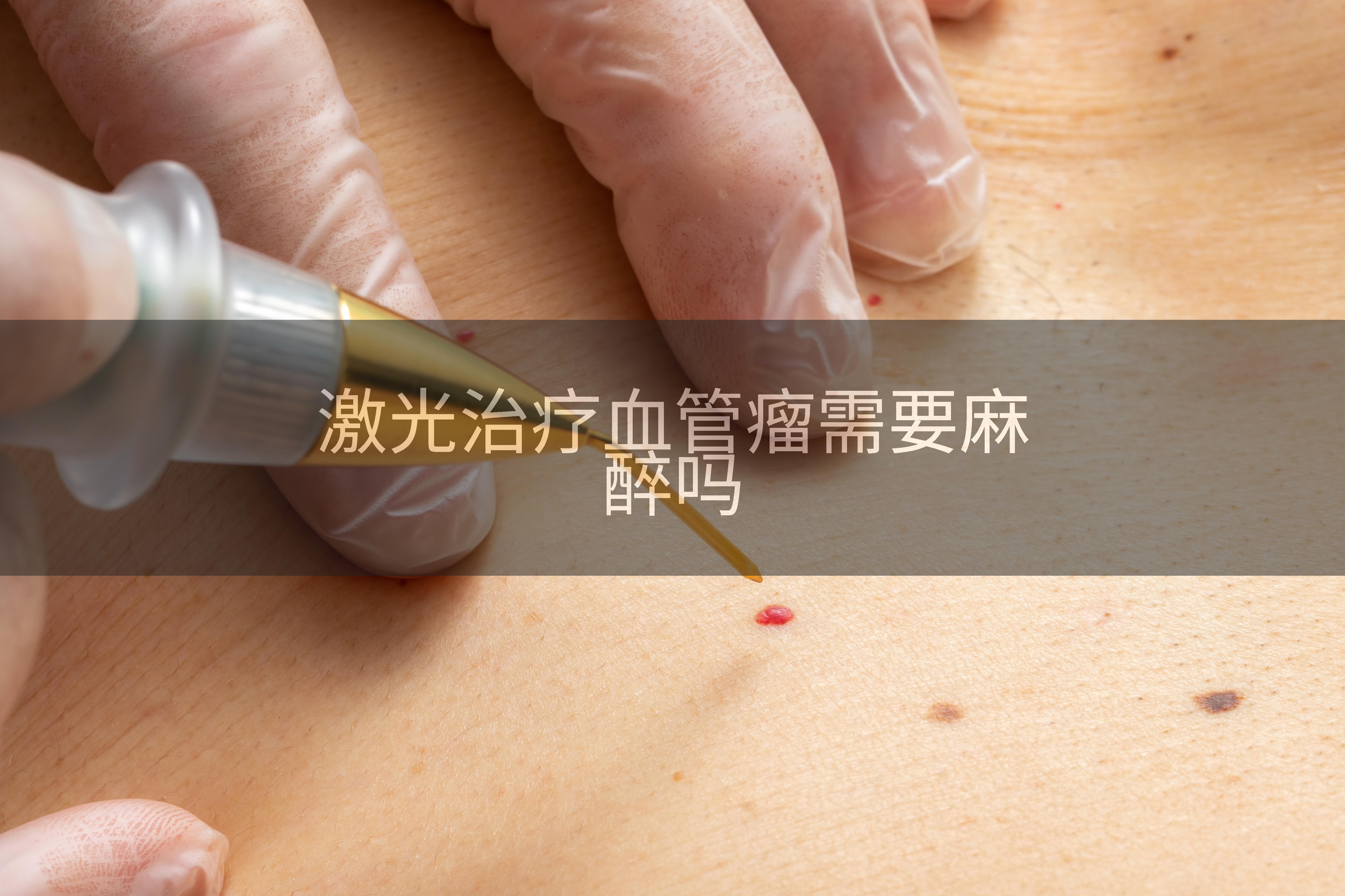 激光治疗血管瘤需要麻醉吗