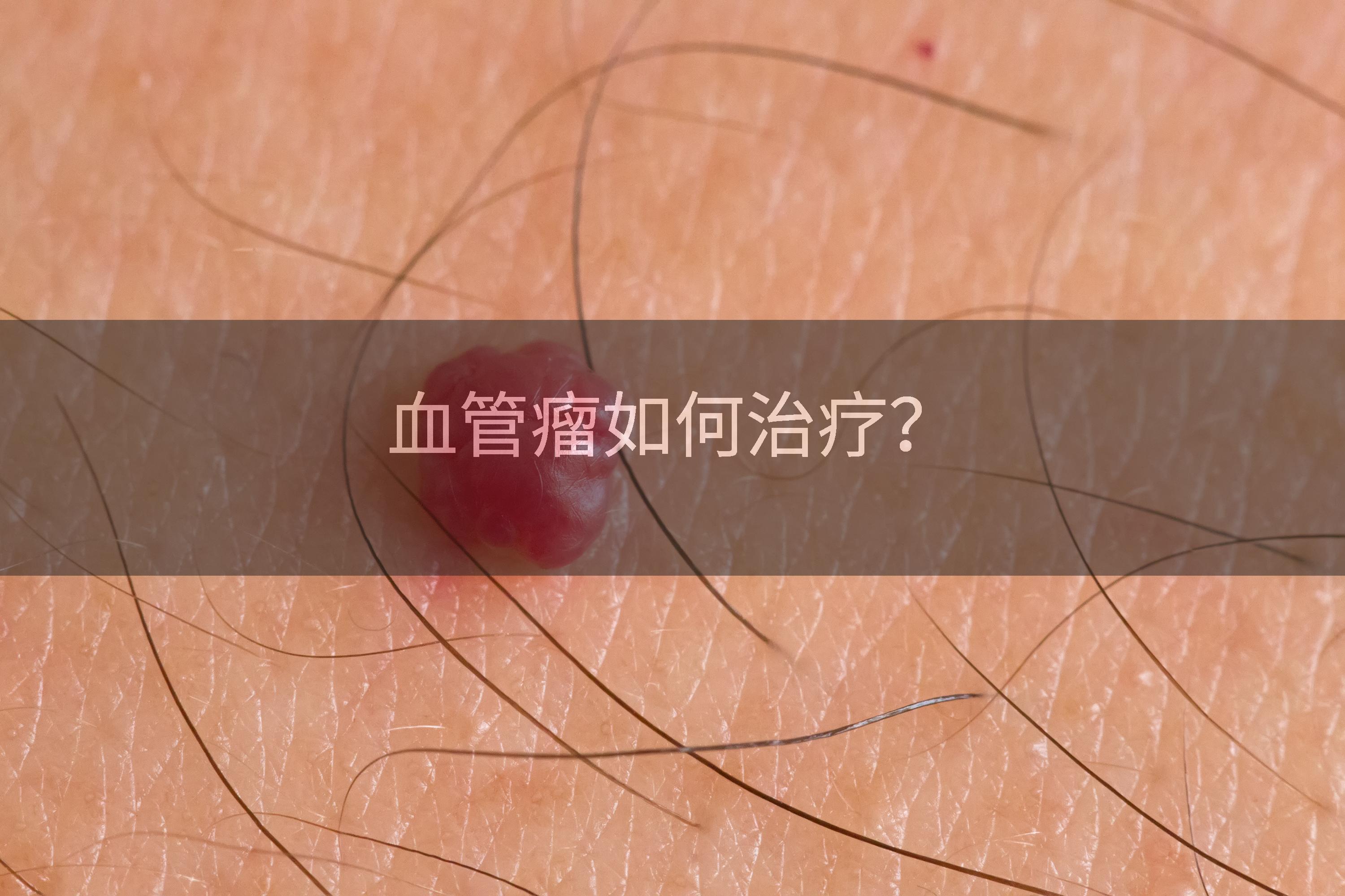 血管瘤如何治疗？