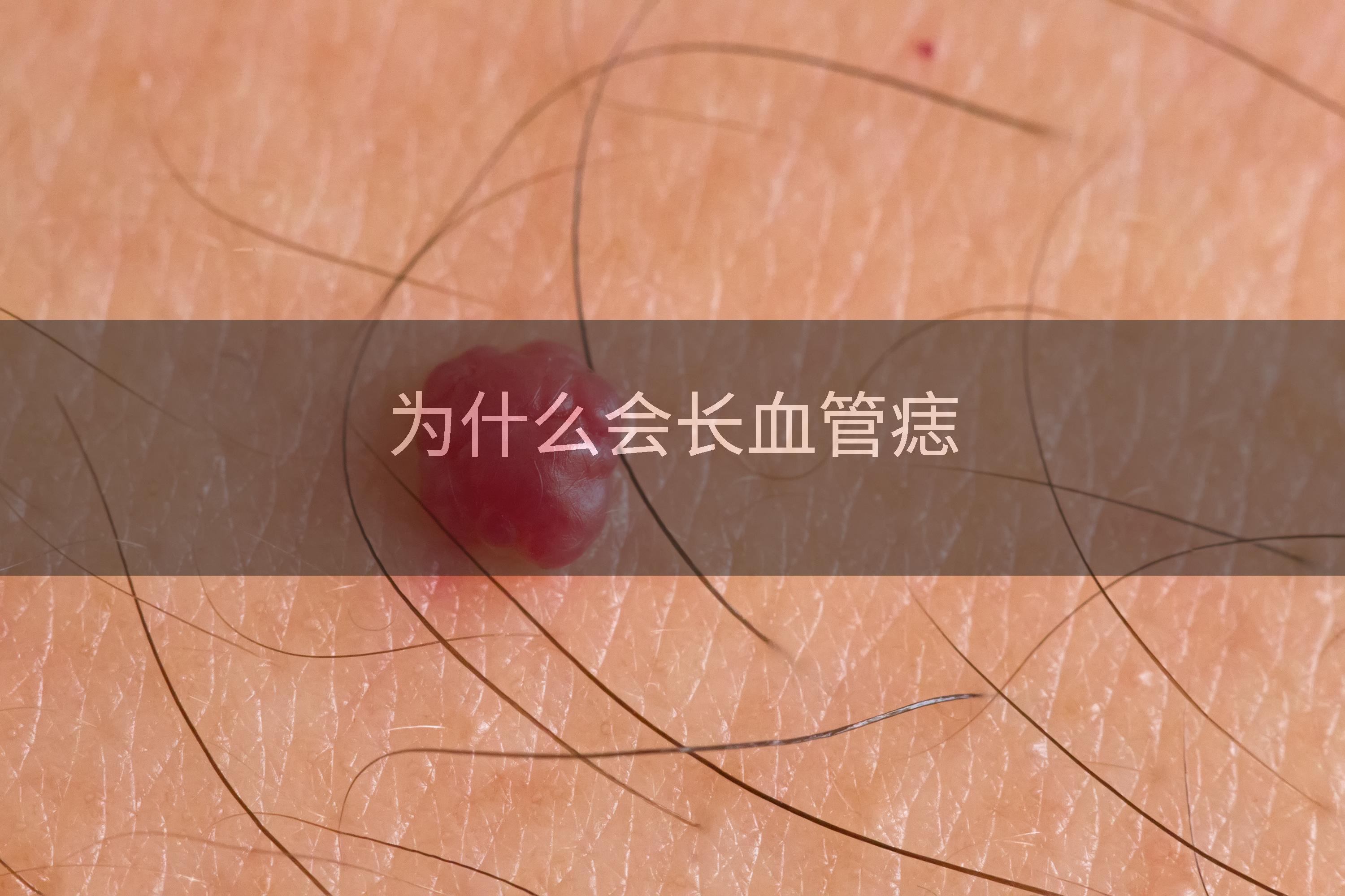 为什么会长血管痣
