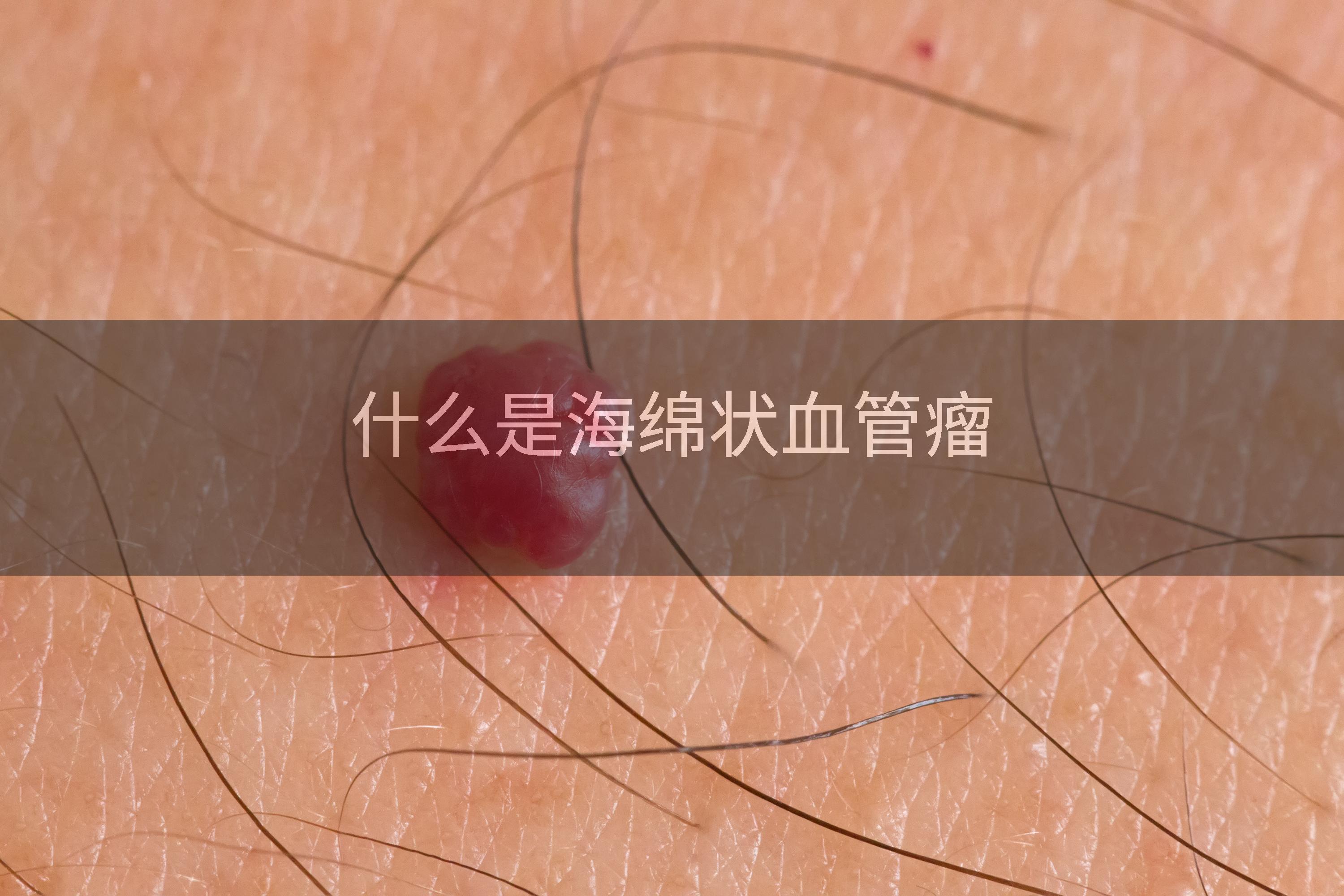 什么是海绵状血管瘤