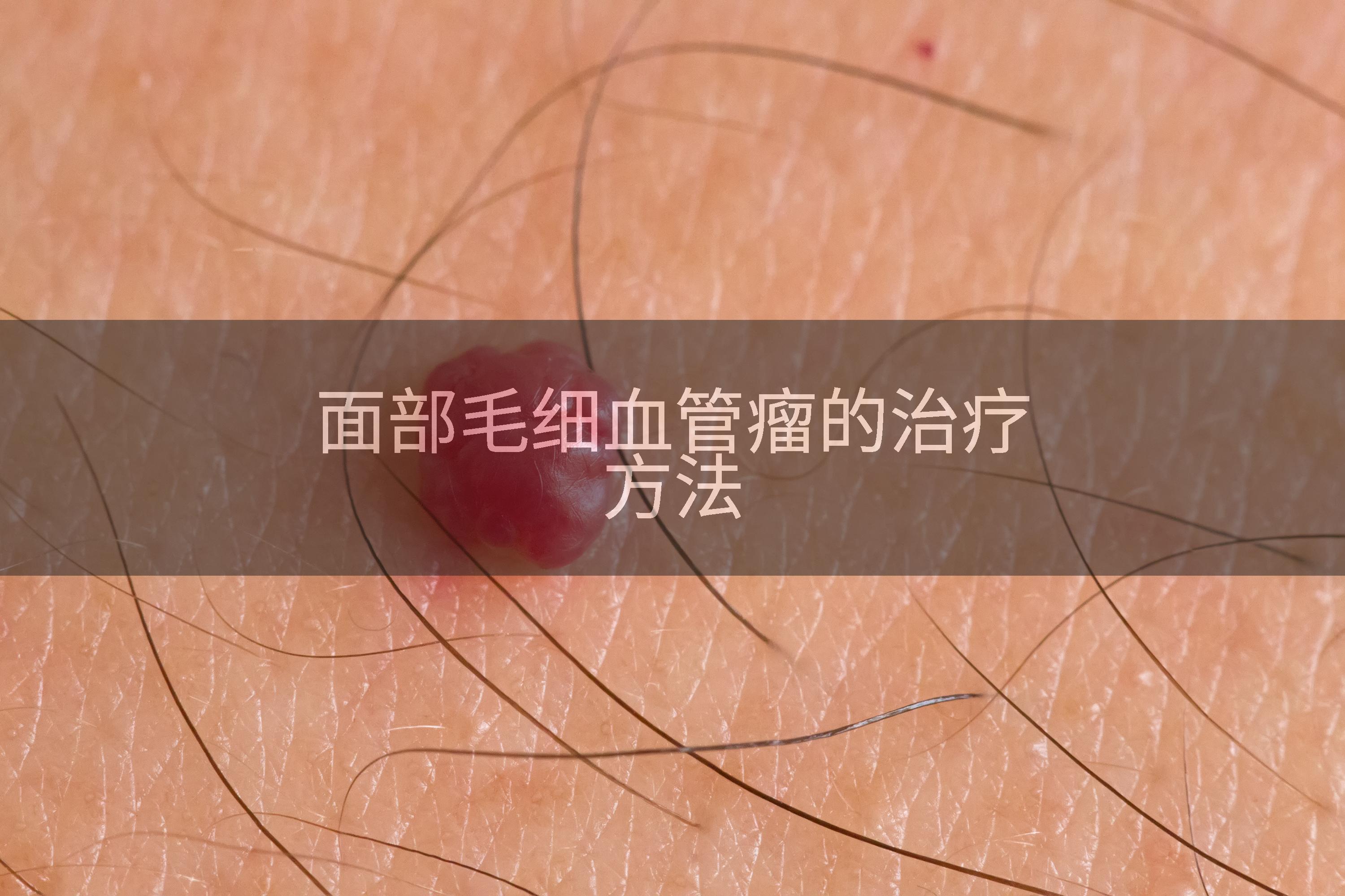 面部毛细血管瘤的治疗方法