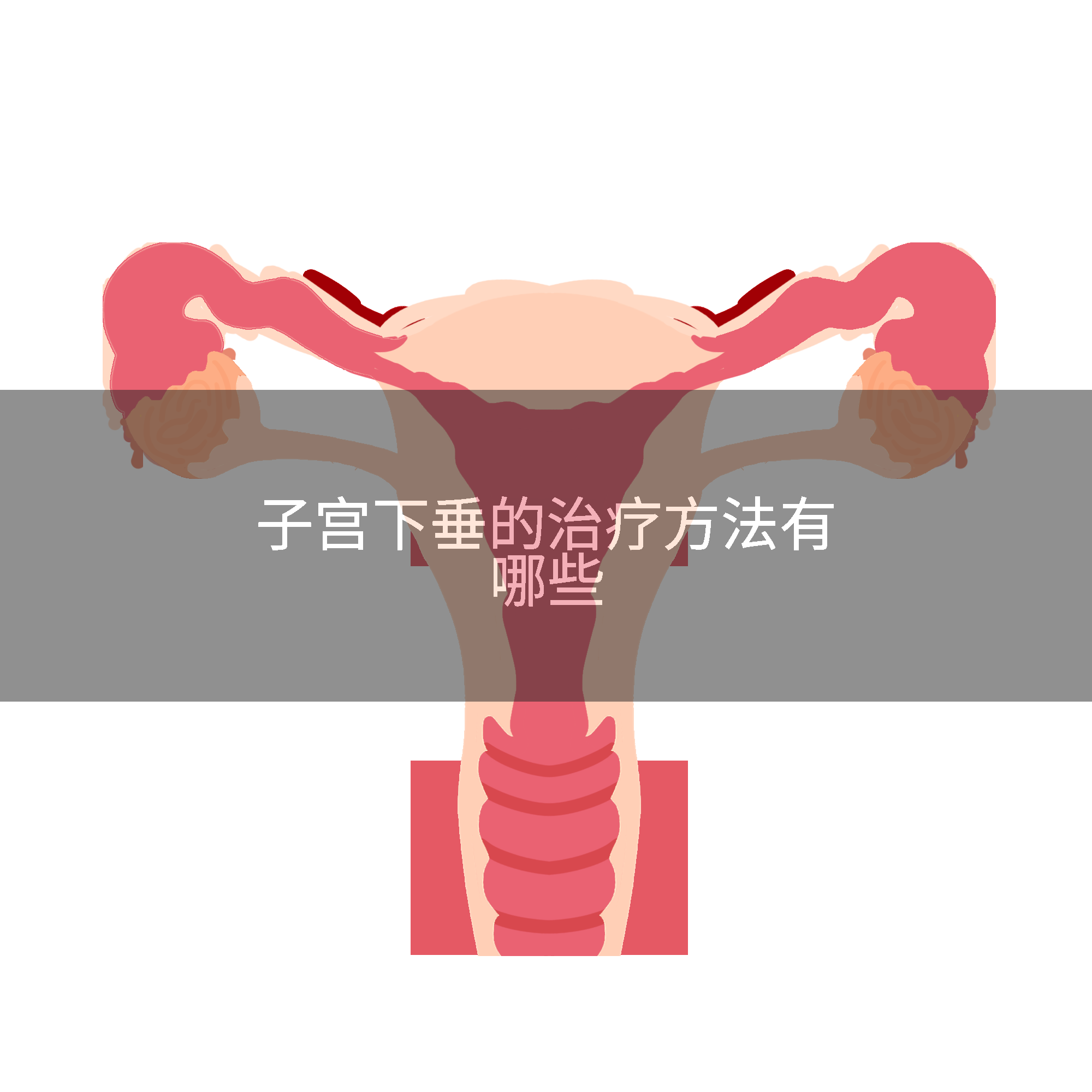 子宫下垂的治疗方法有哪些