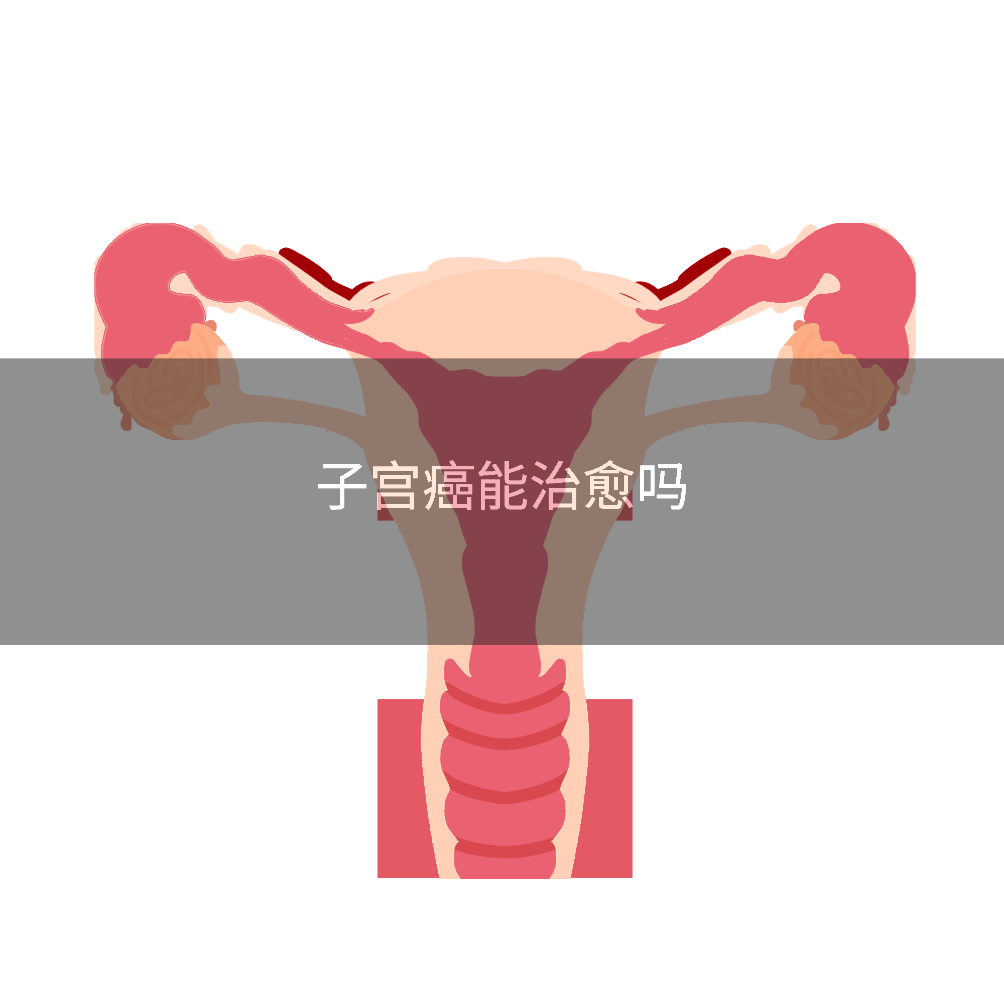 子宫癌能治愈吗