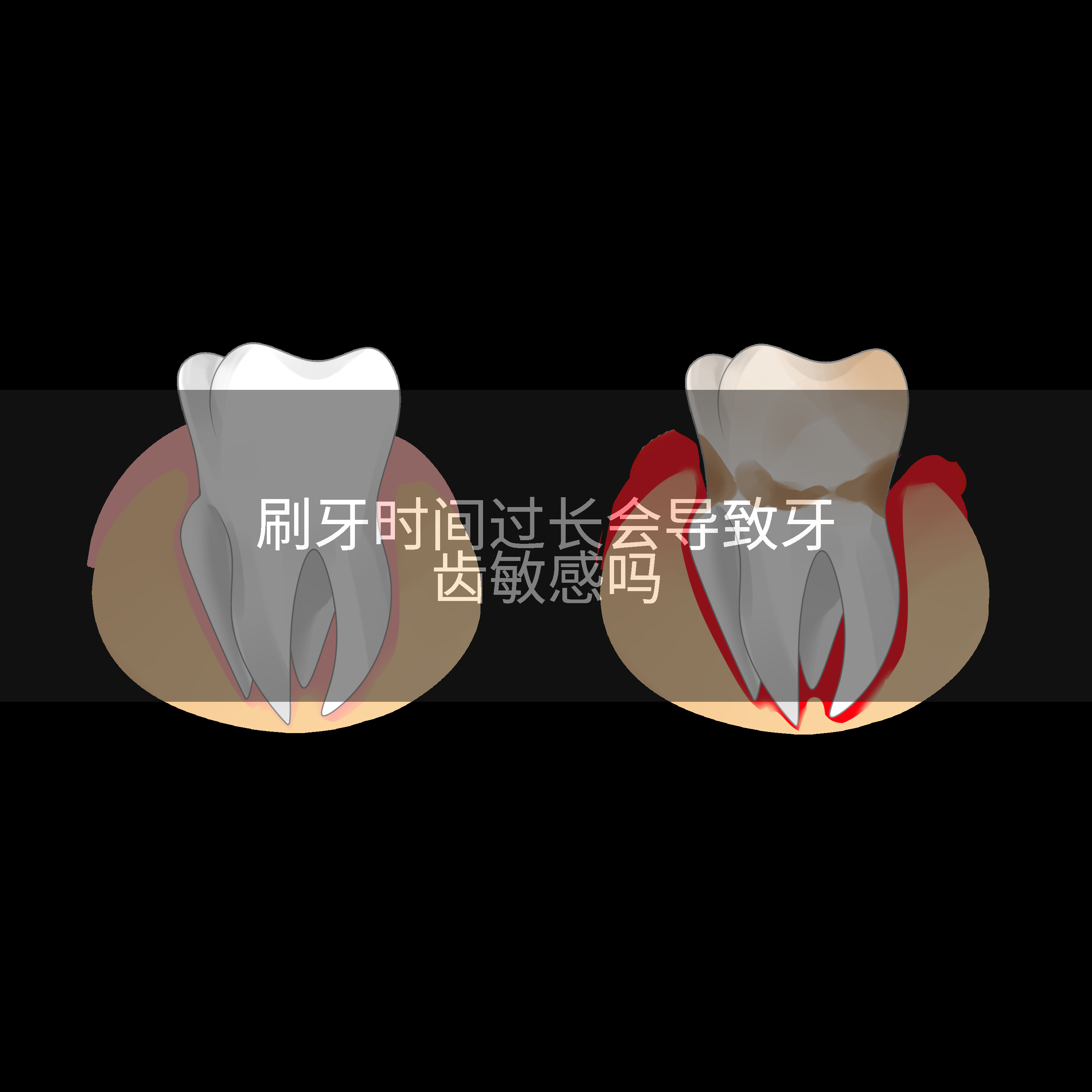 刷牙时间过长会导致牙齿敏感吗