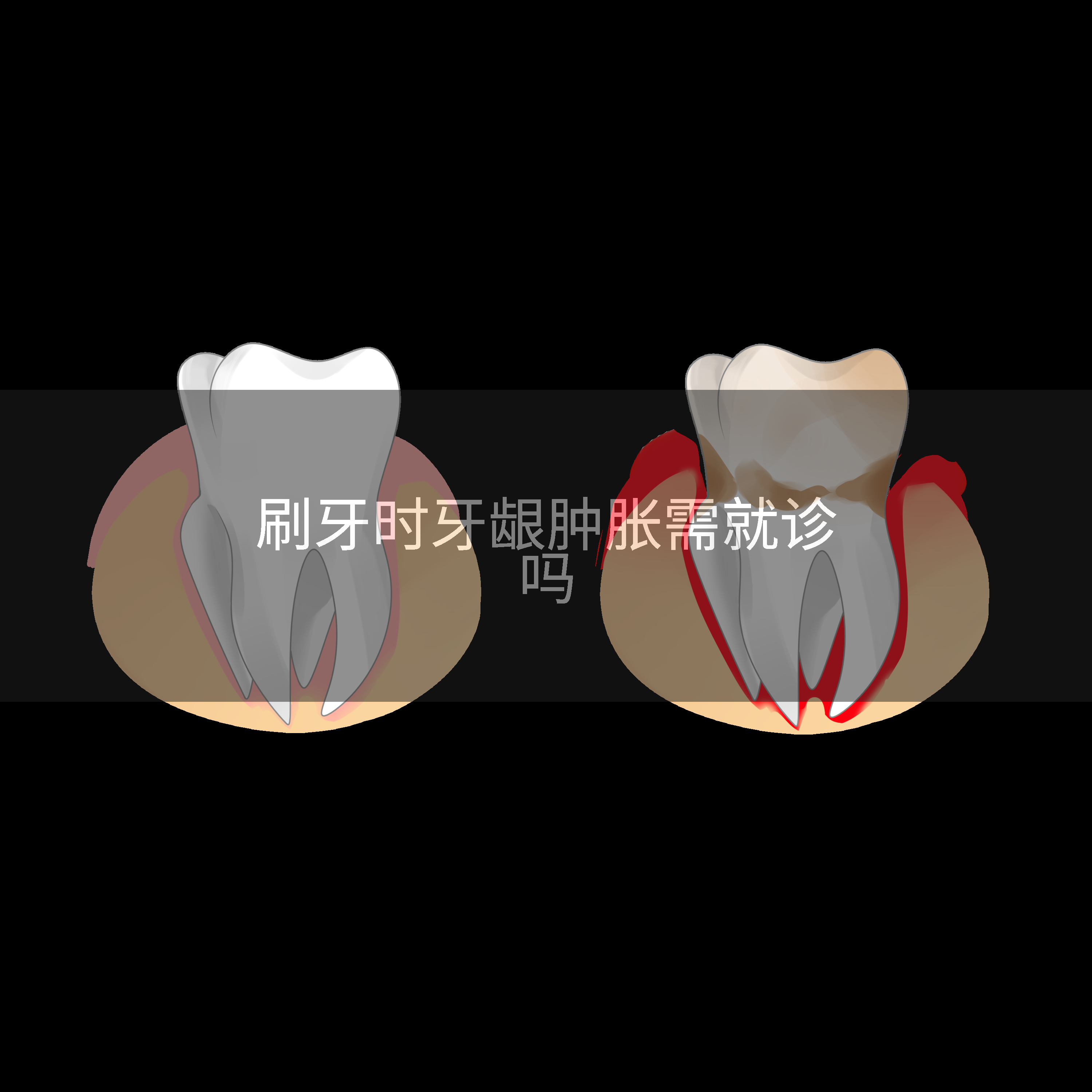 刷牙时牙龈肿胀需就诊吗