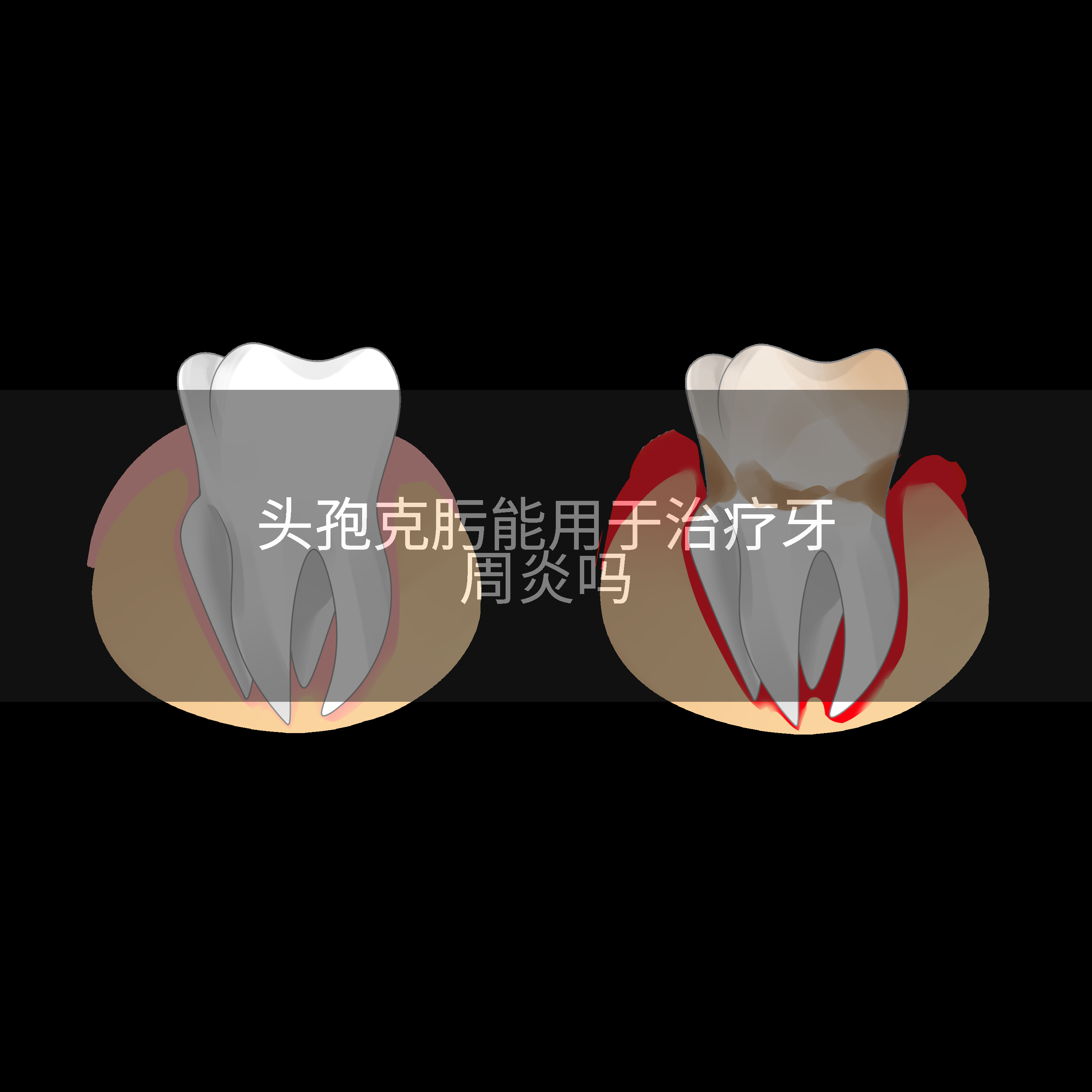 头孢克肟能用于治疗牙周炎吗