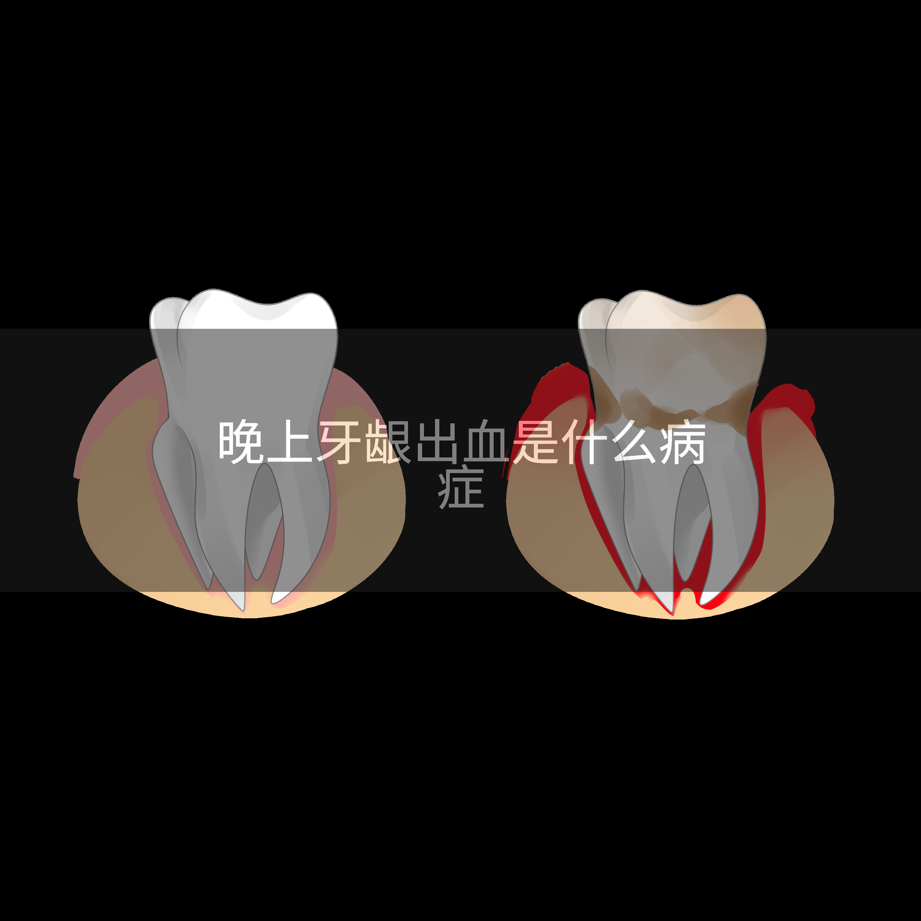 晚上牙龈出血是什么病症