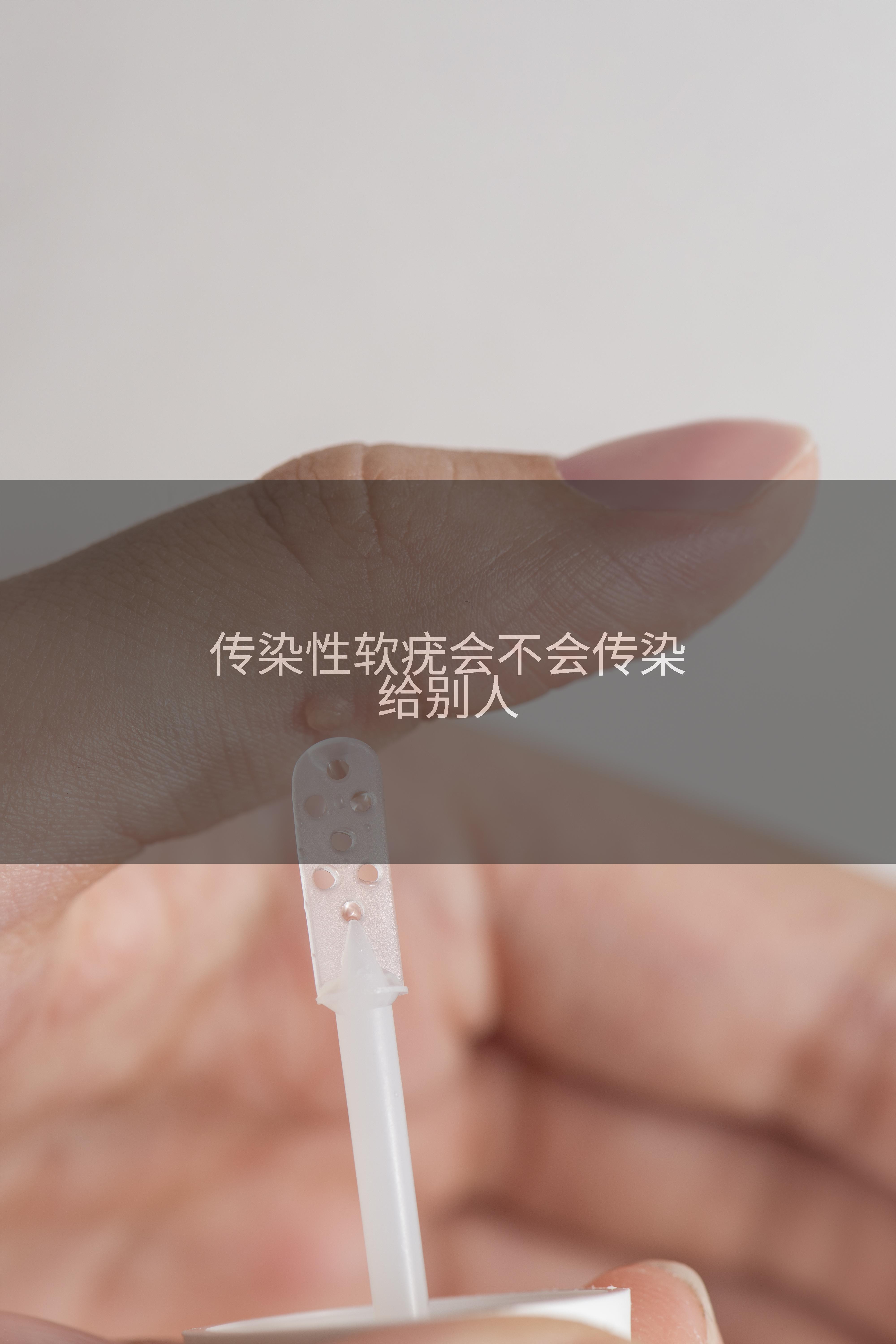 传染性软疣会不会传染给别人