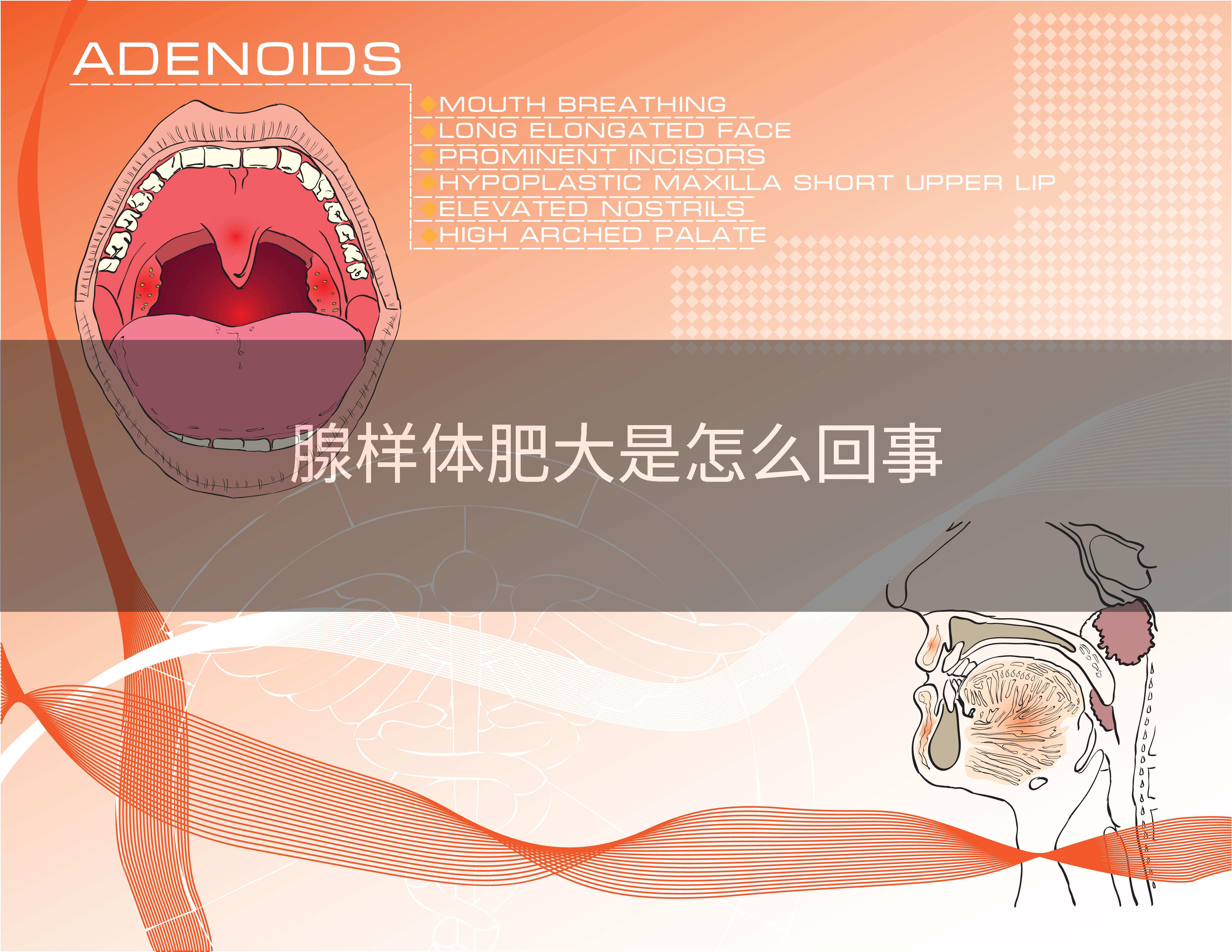 腺样体肥大是怎么回事