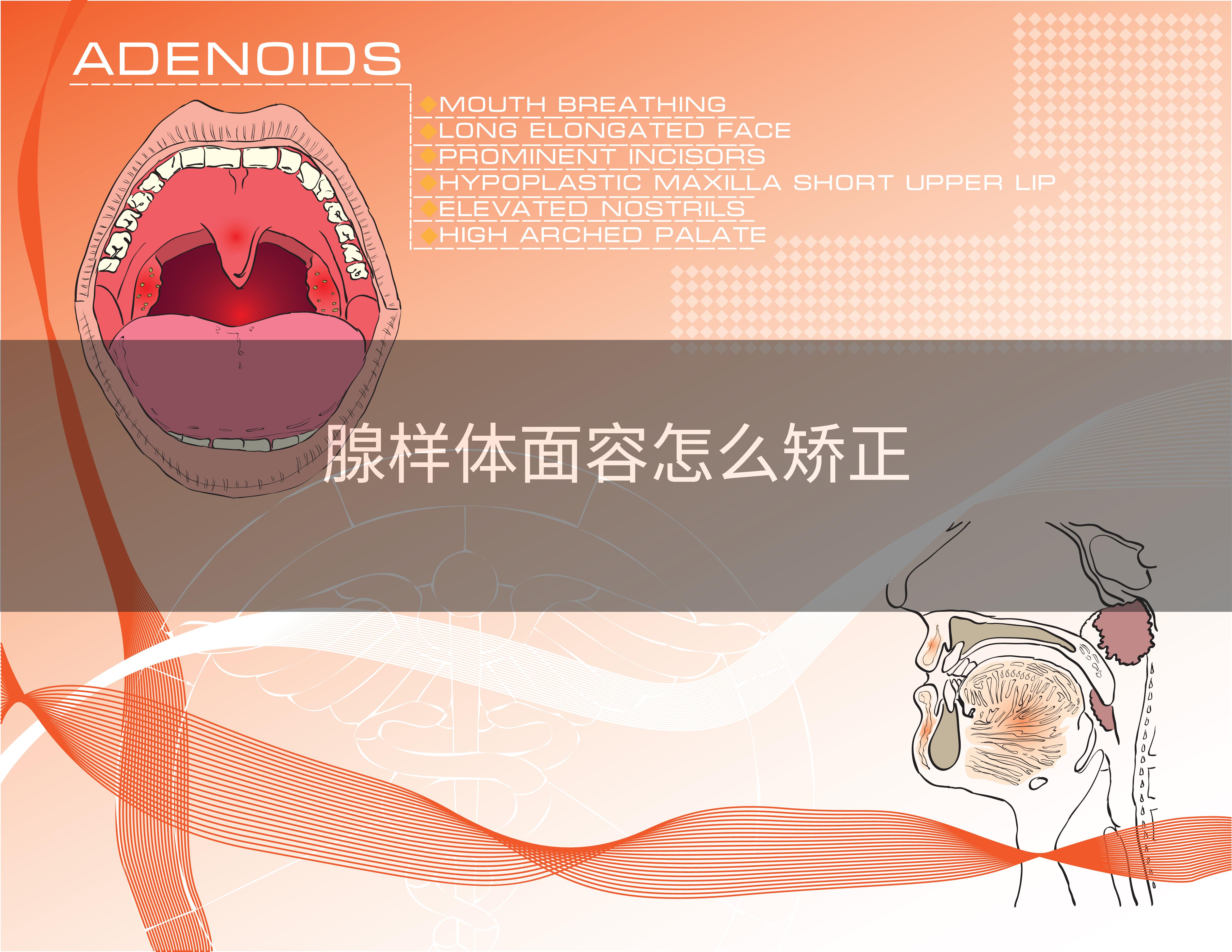 腺样体面容怎么矫正