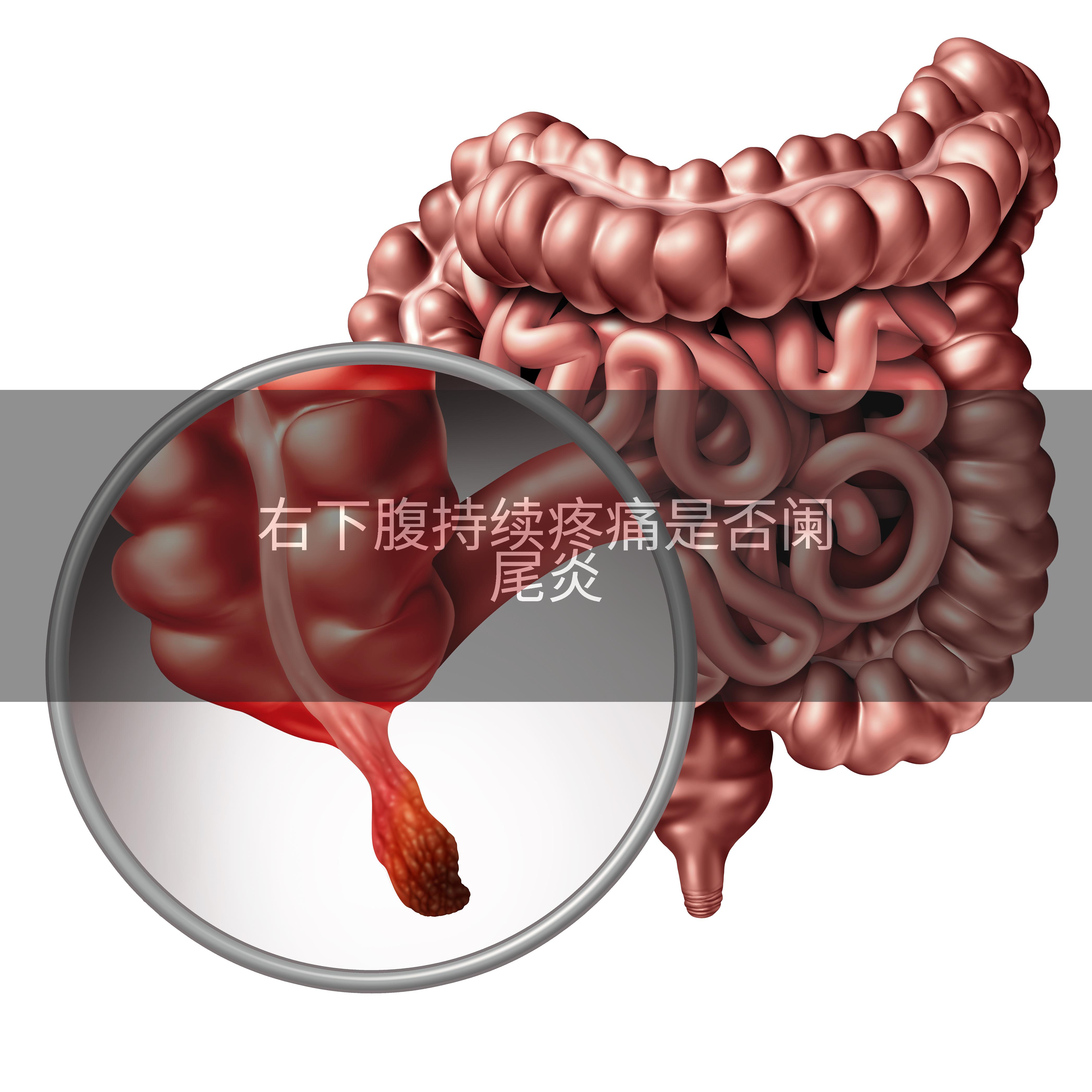 右下腹持续疼痛是否阑尾炎