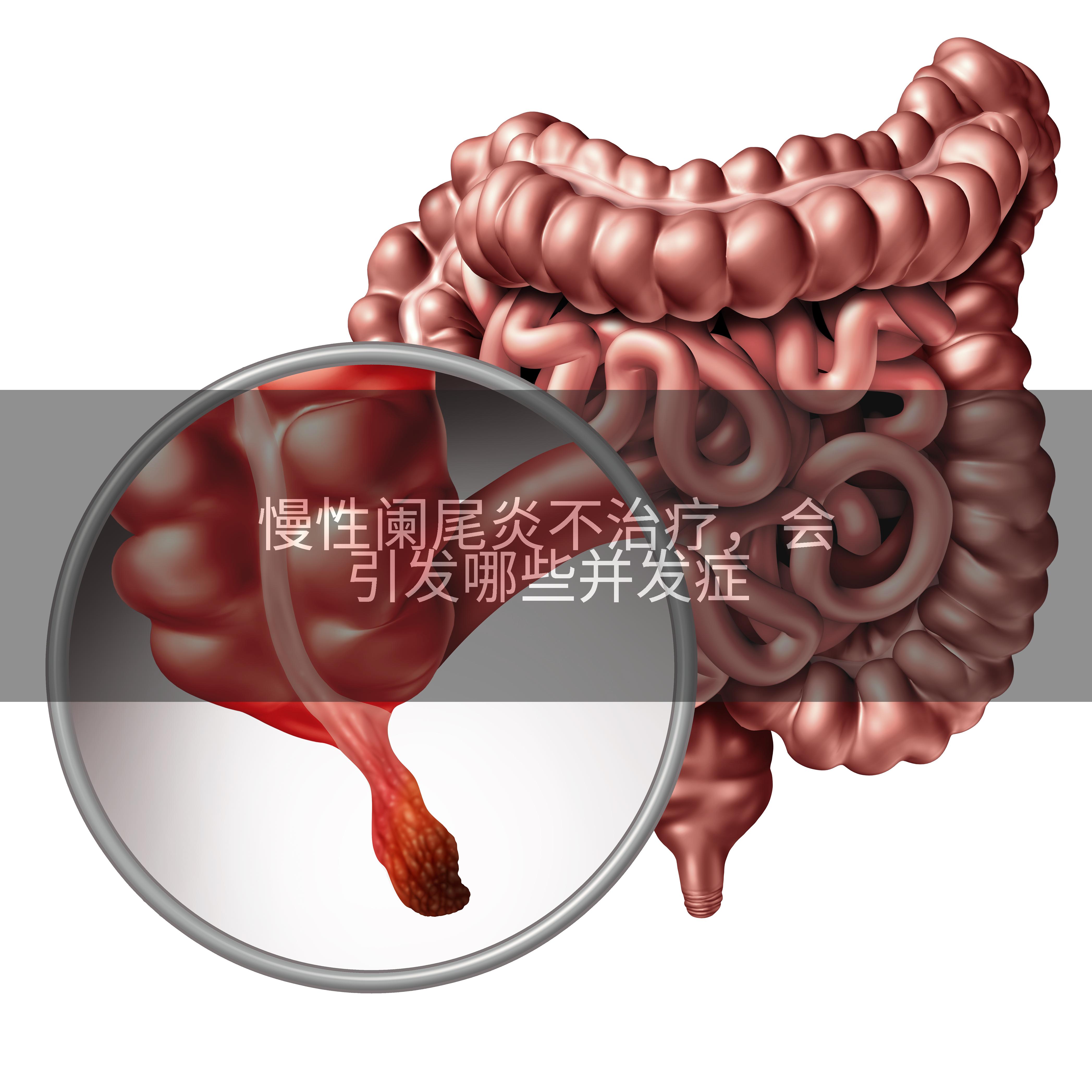慢性阑尾炎不治疗，会引发哪些并发症