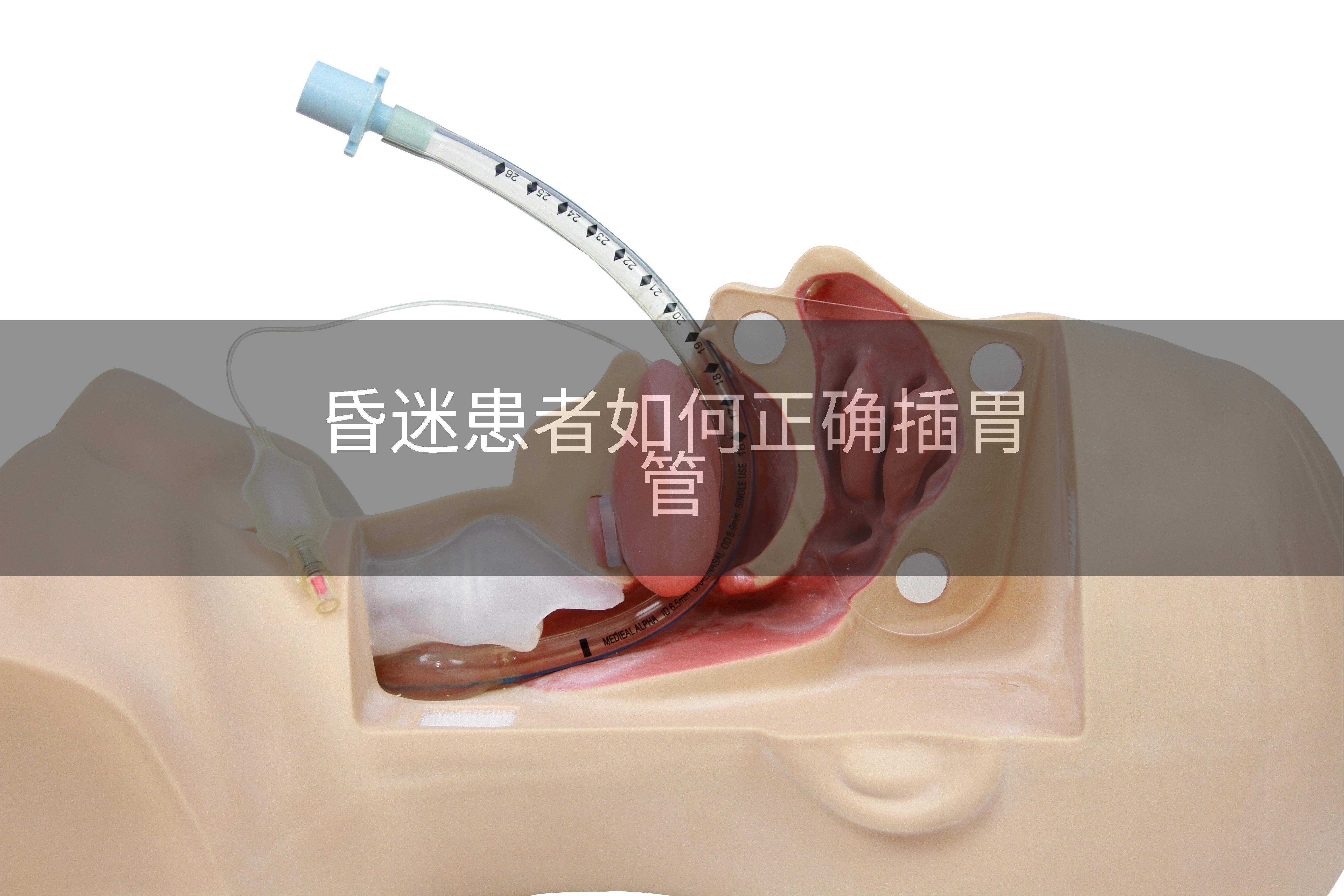 昏迷患者如何正确插胃管