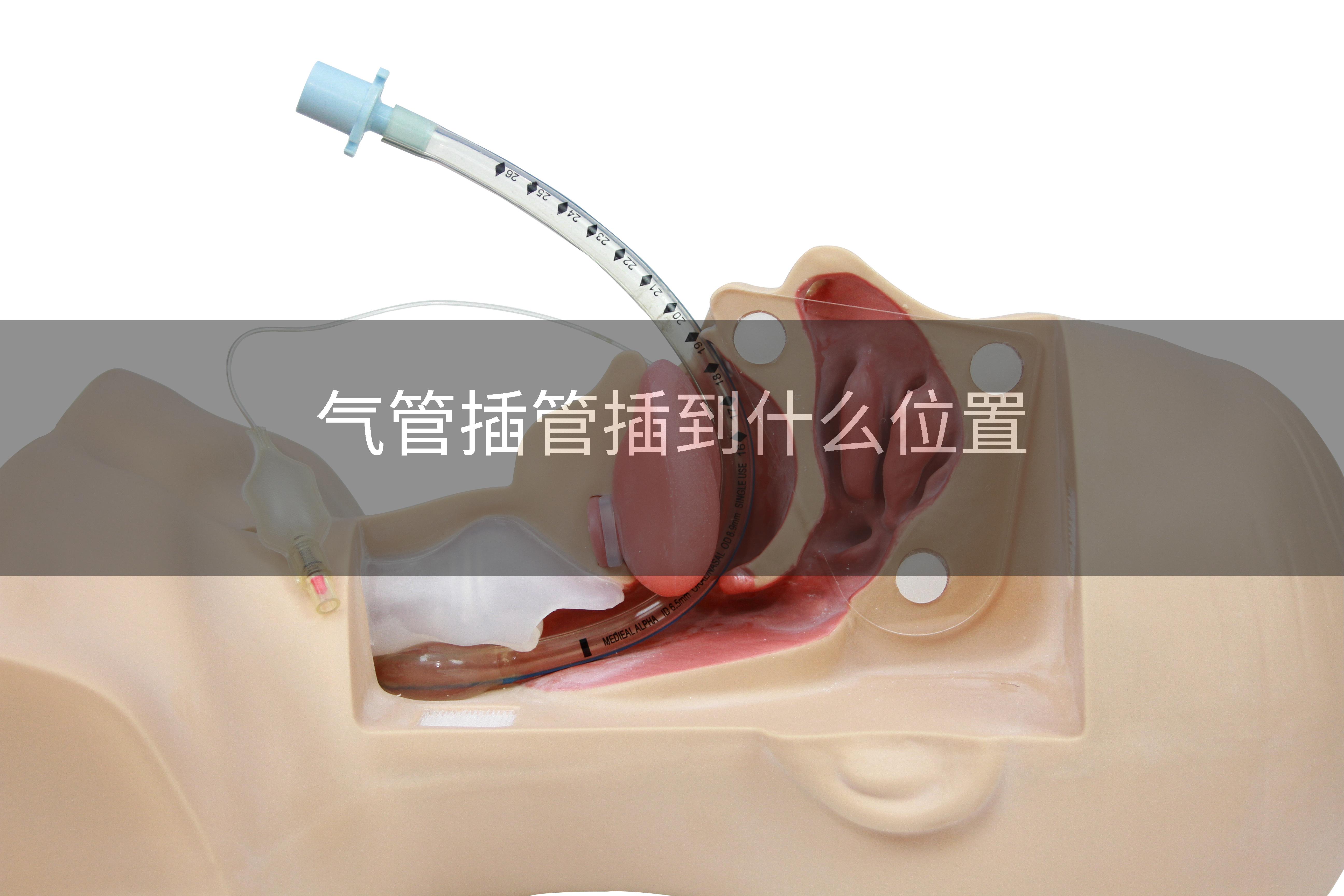 气管插管插到什么位置