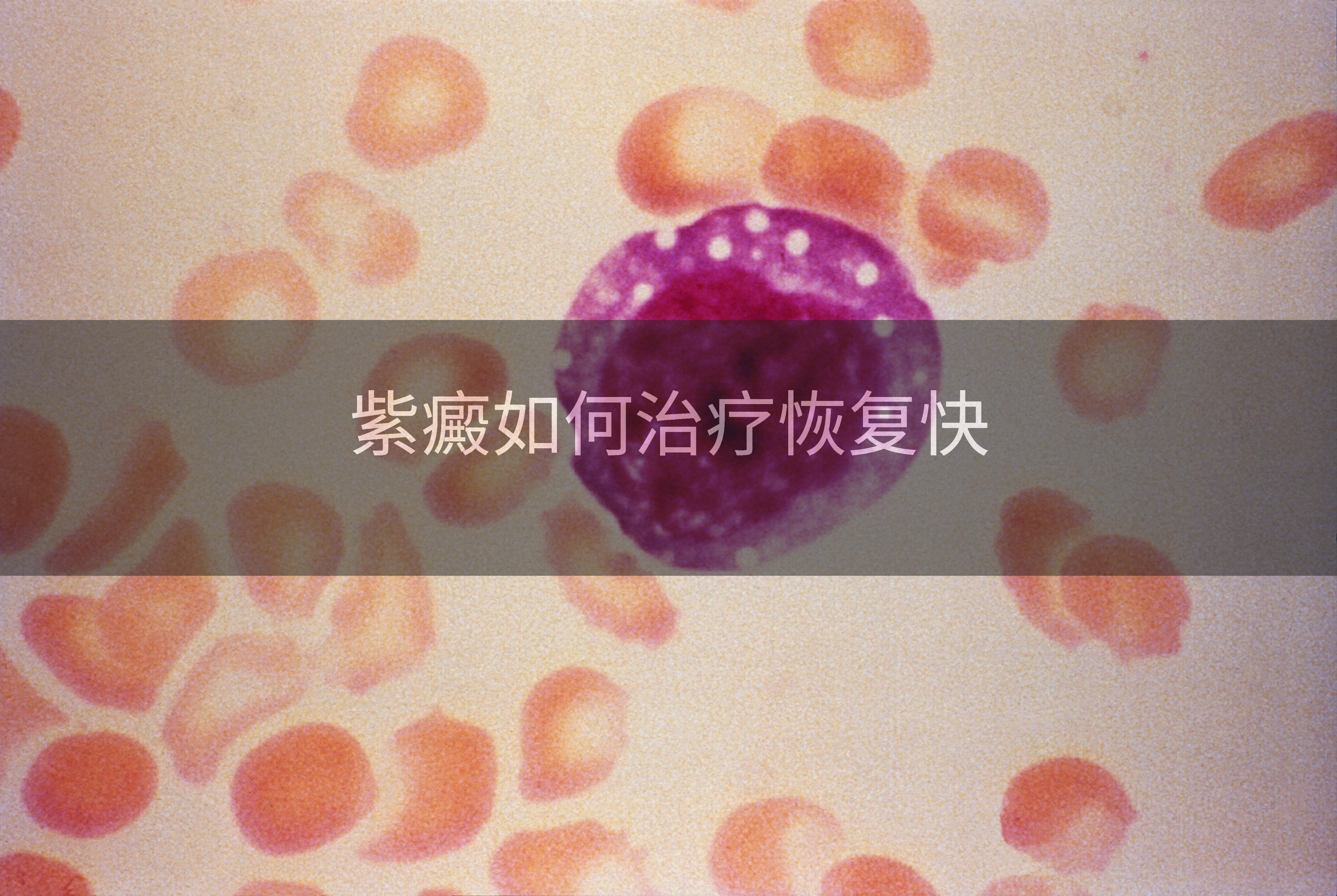 紫癜如何治疗恢复快