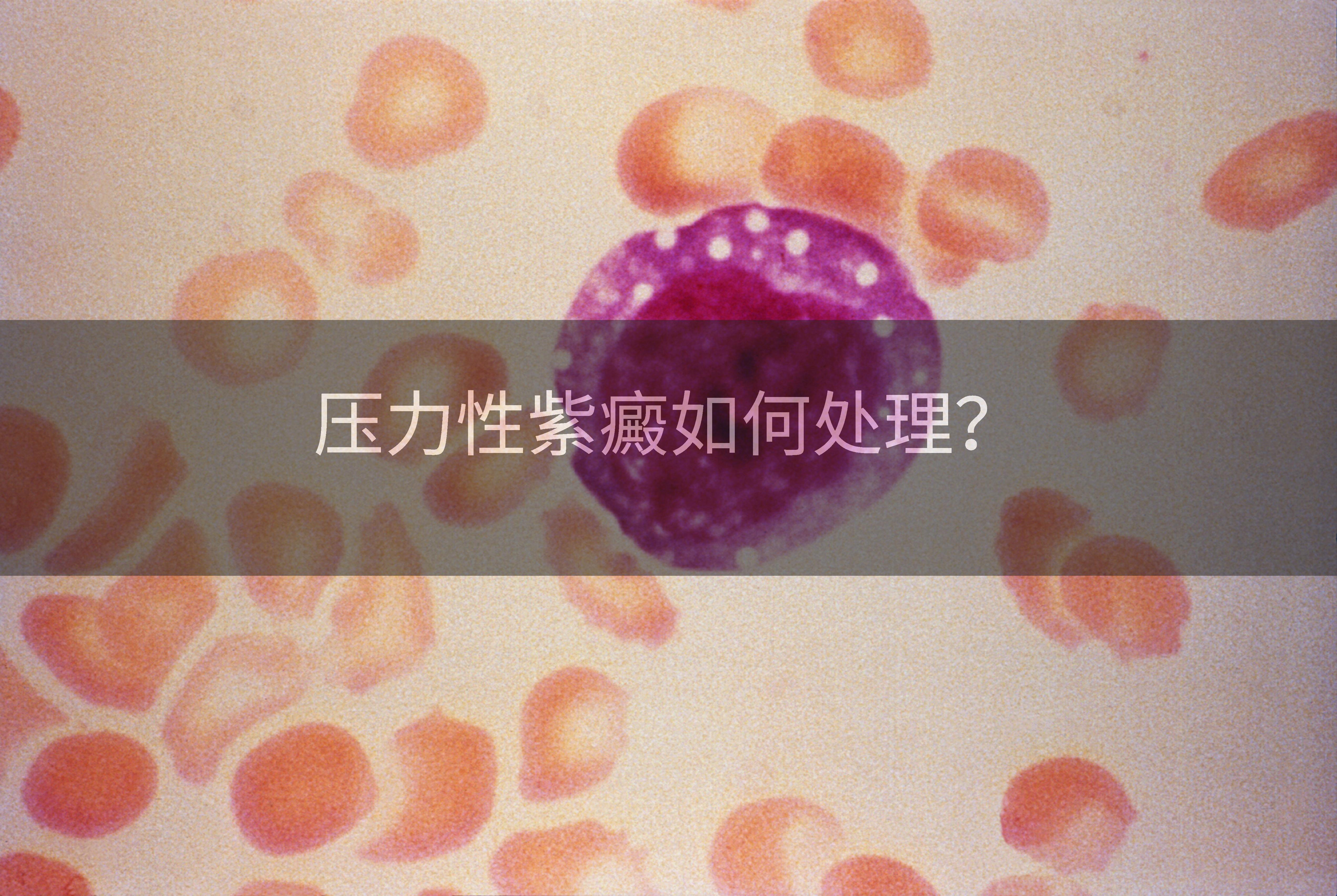 压力性紫癜如何处理？