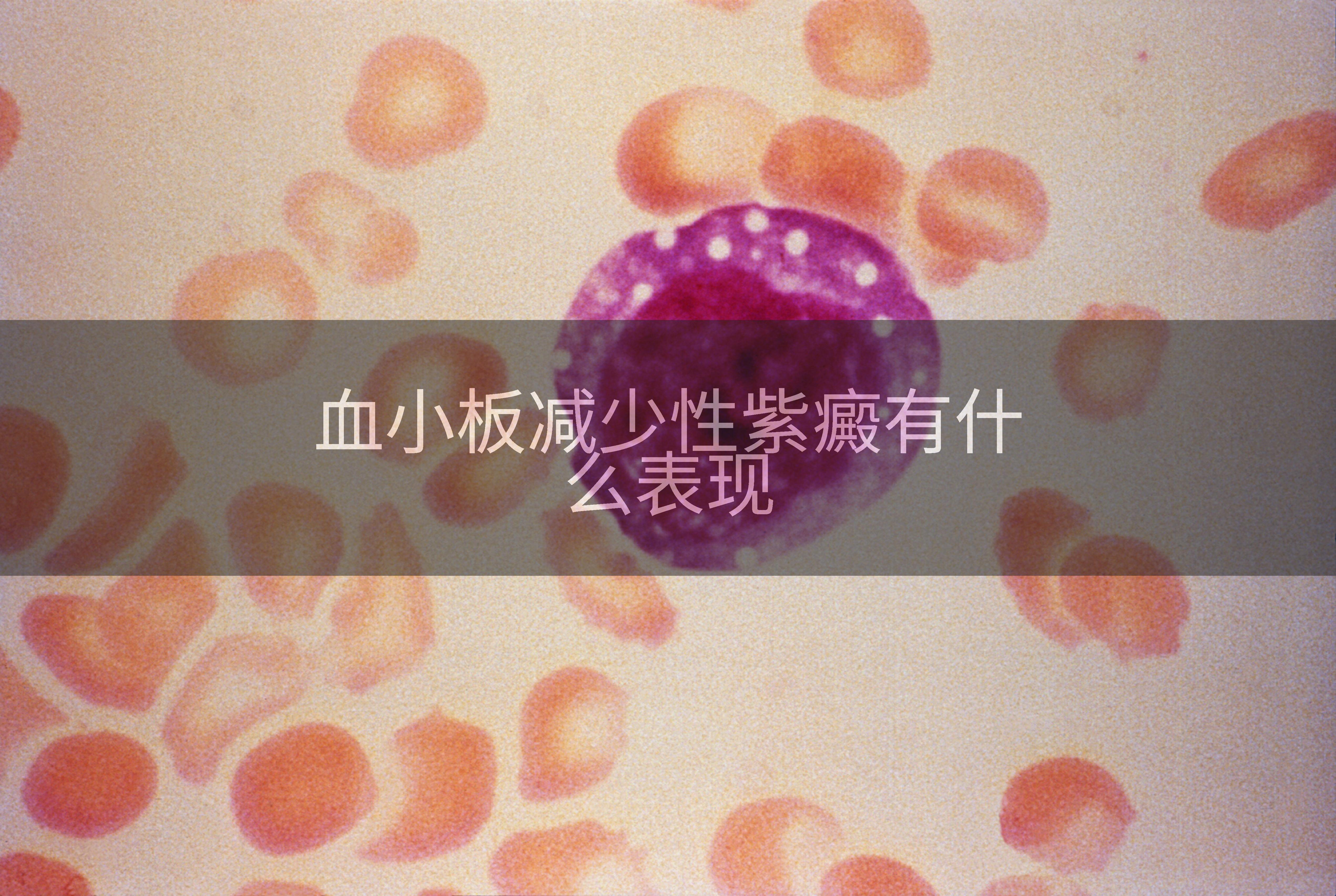 血小板减少性紫癜有什么表现