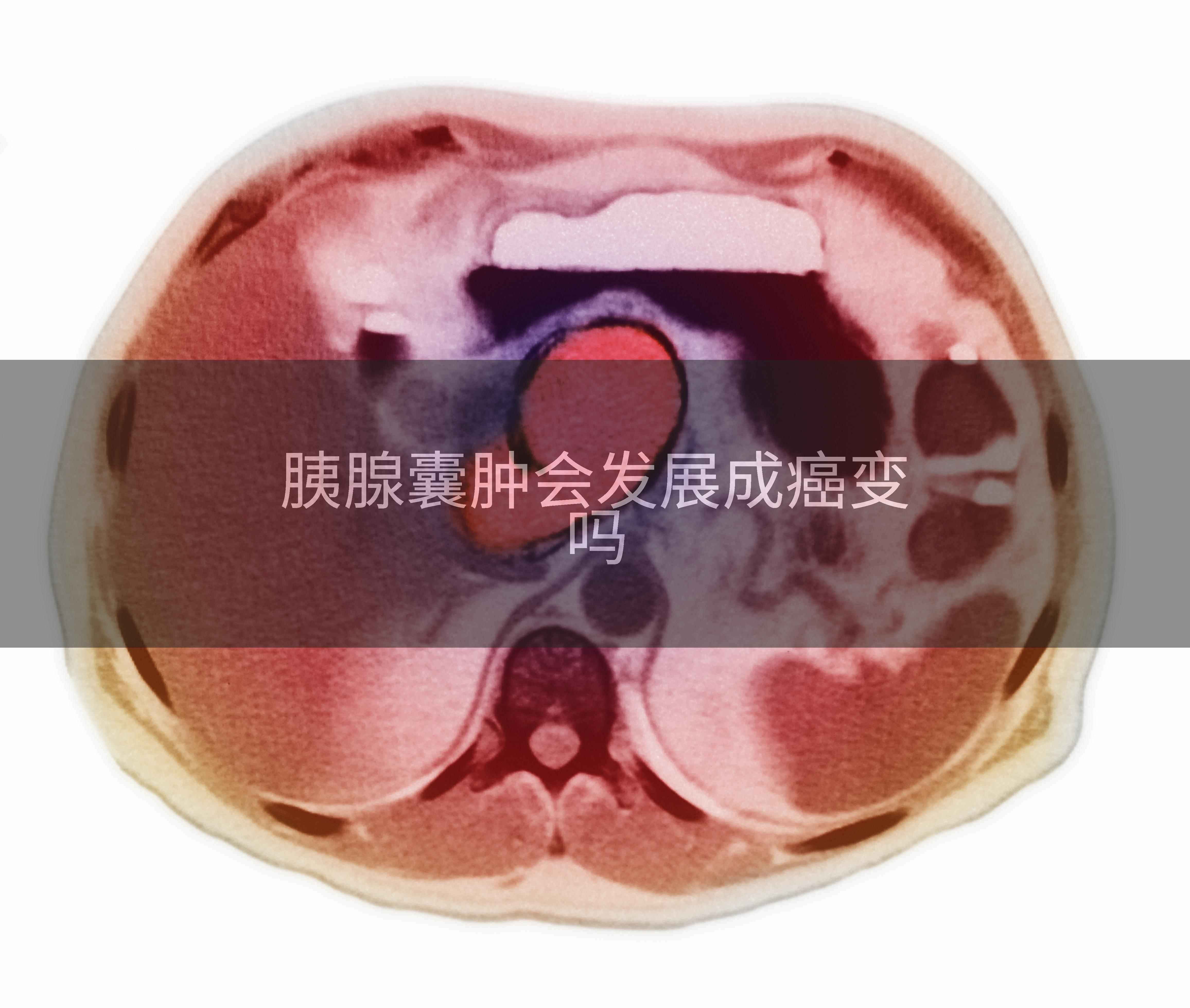 胰腺囊肿会发展成癌变吗