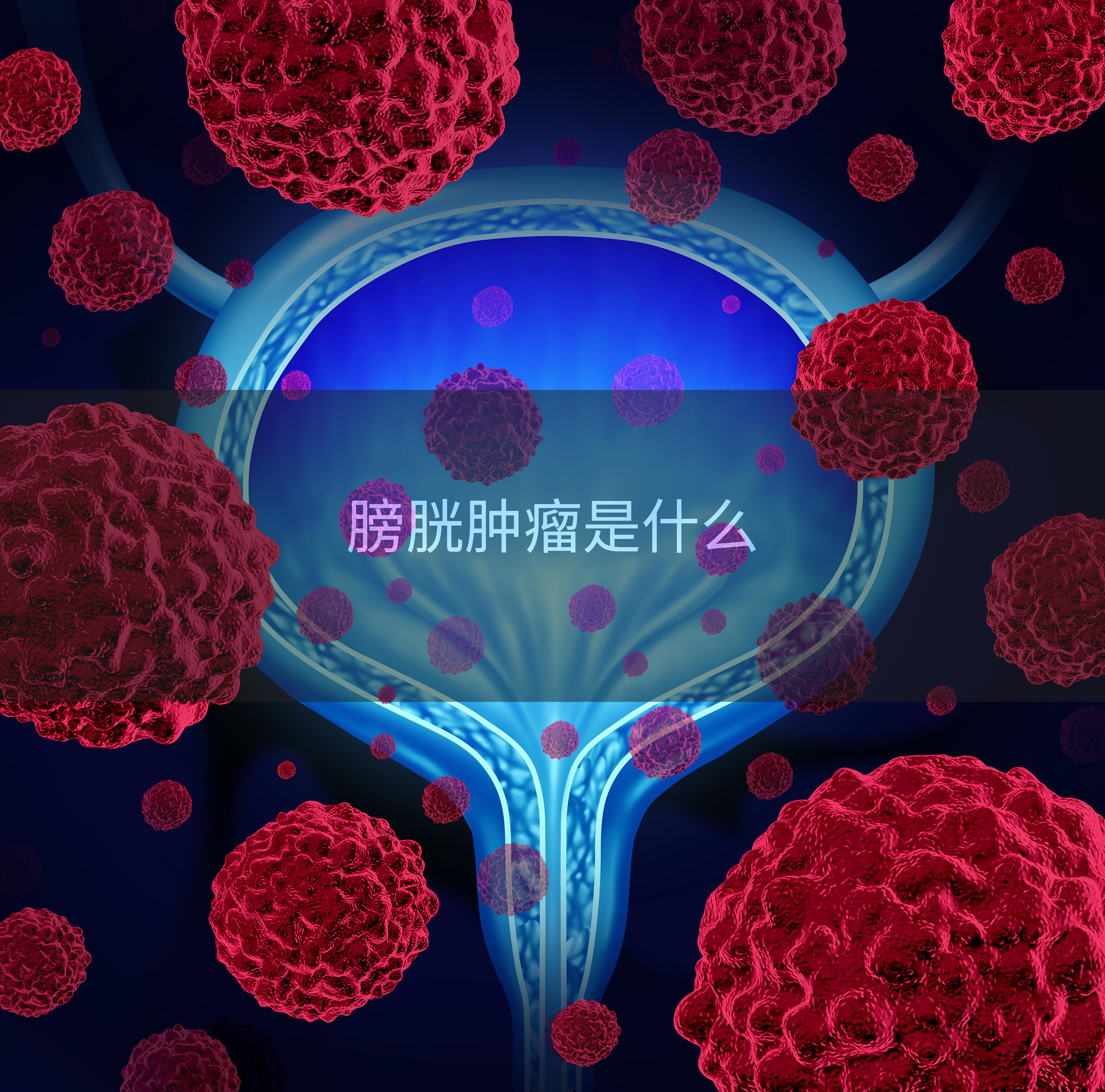 膀胱肿瘤是什么
