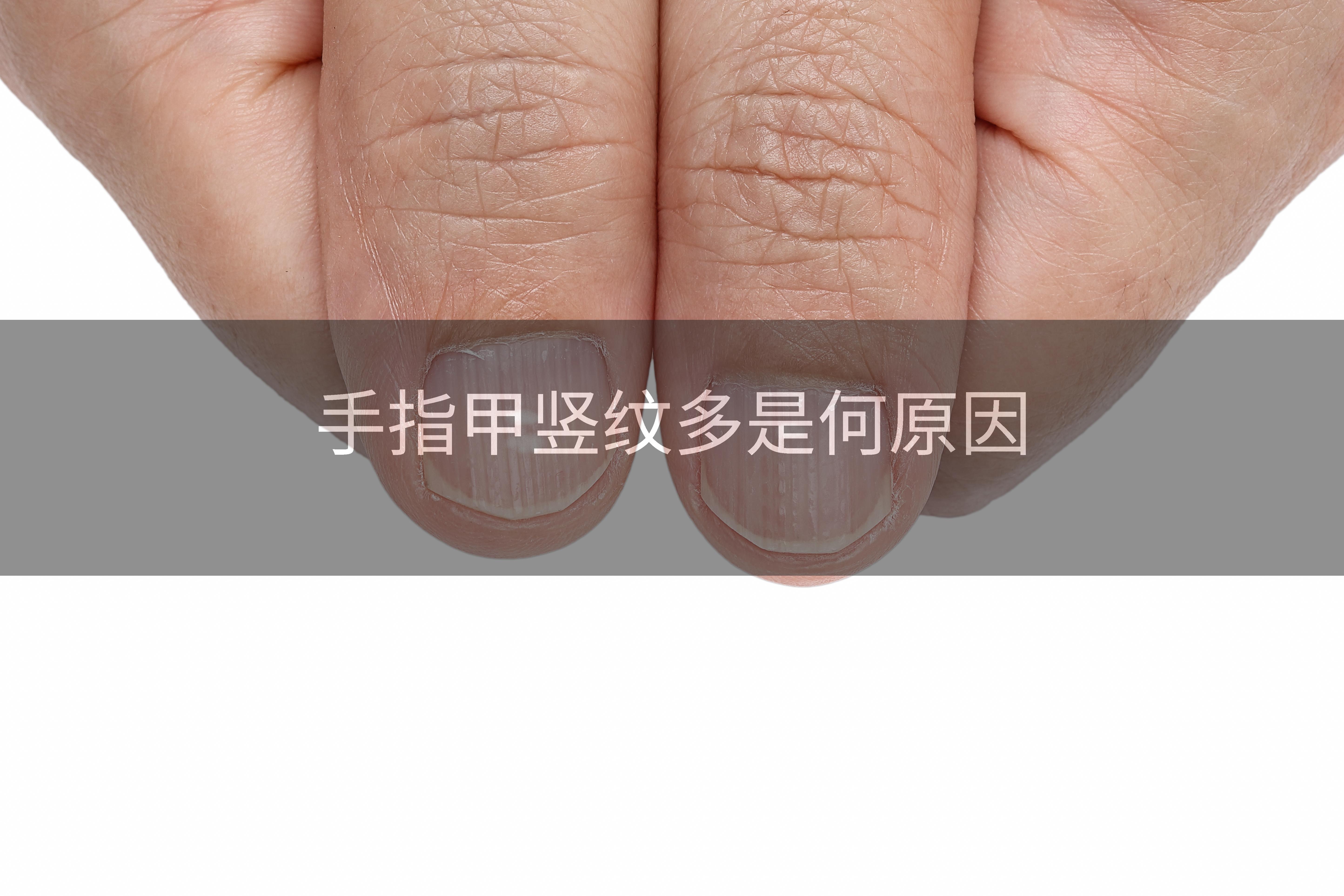 手指甲竖纹多是何原因