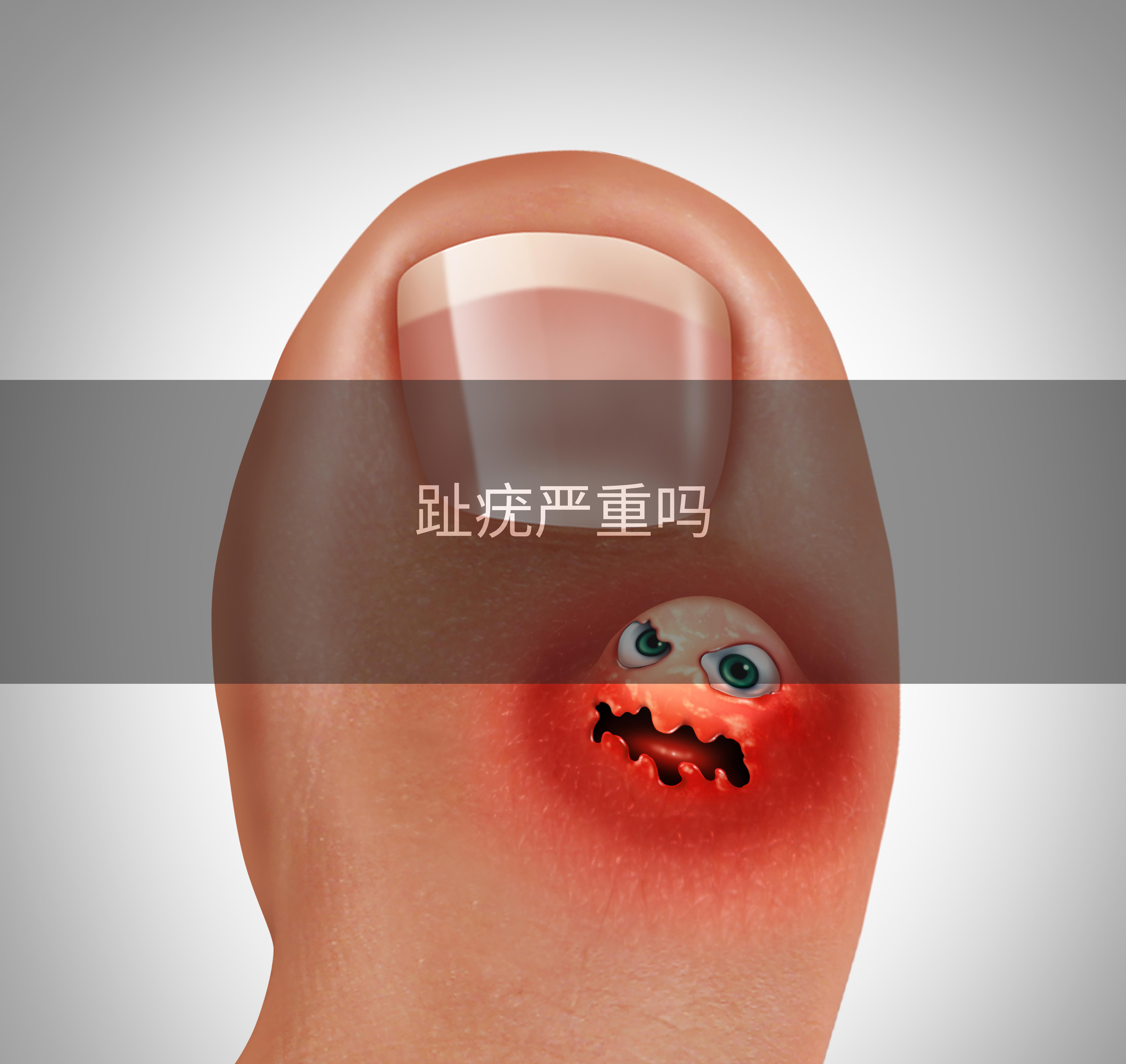 趾疣严重吗