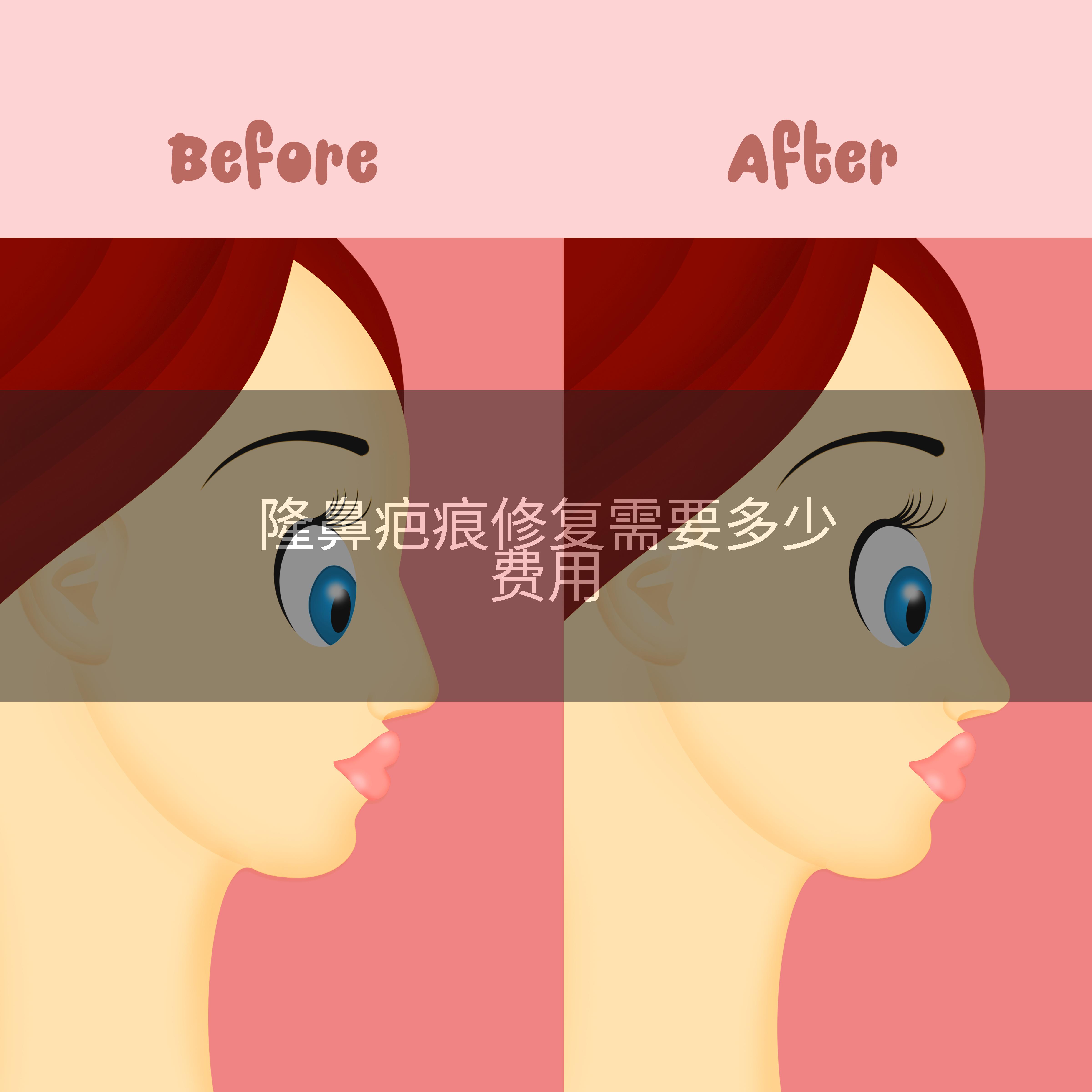 隆鼻疤痕修复需要多少费用