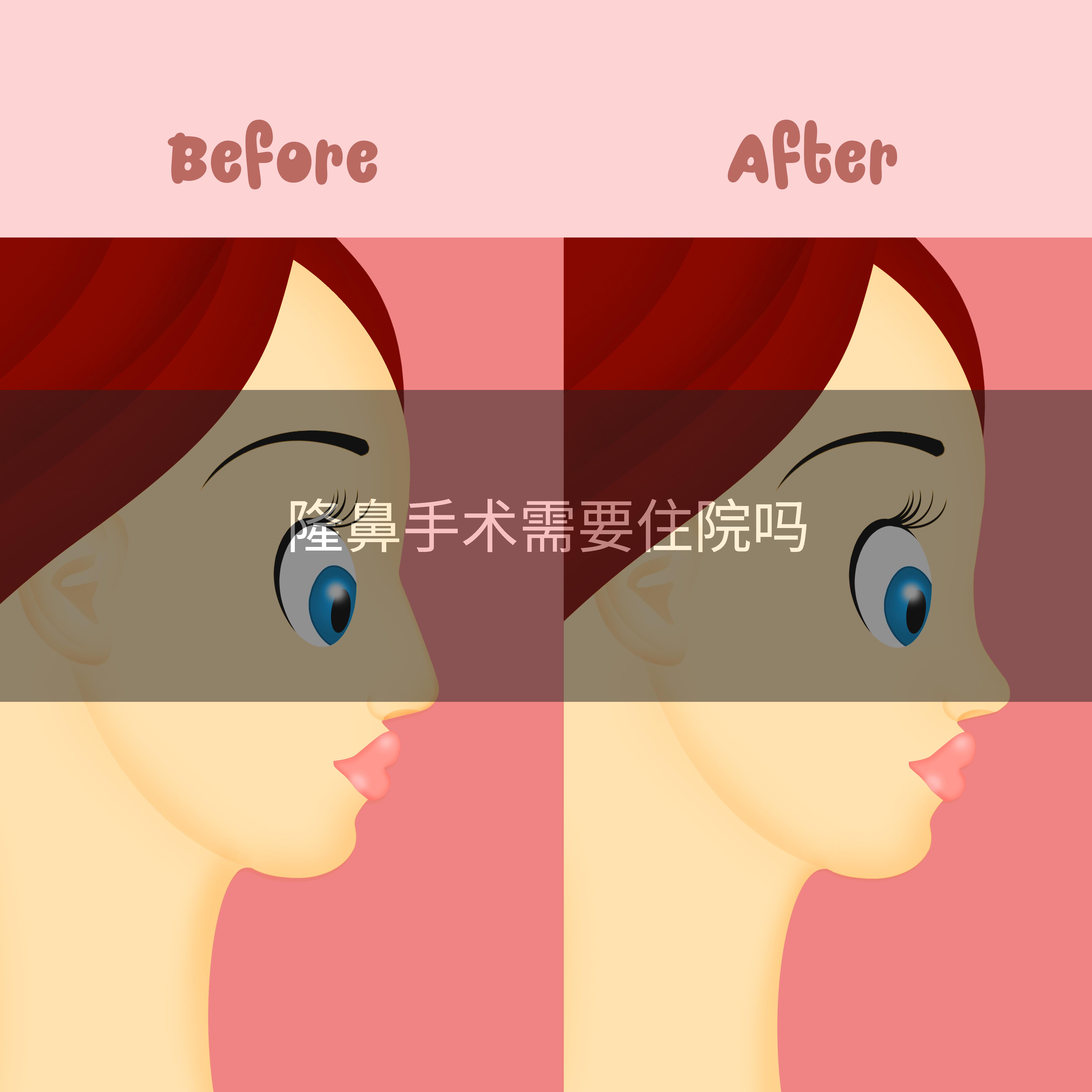 隆鼻手术需要住院吗