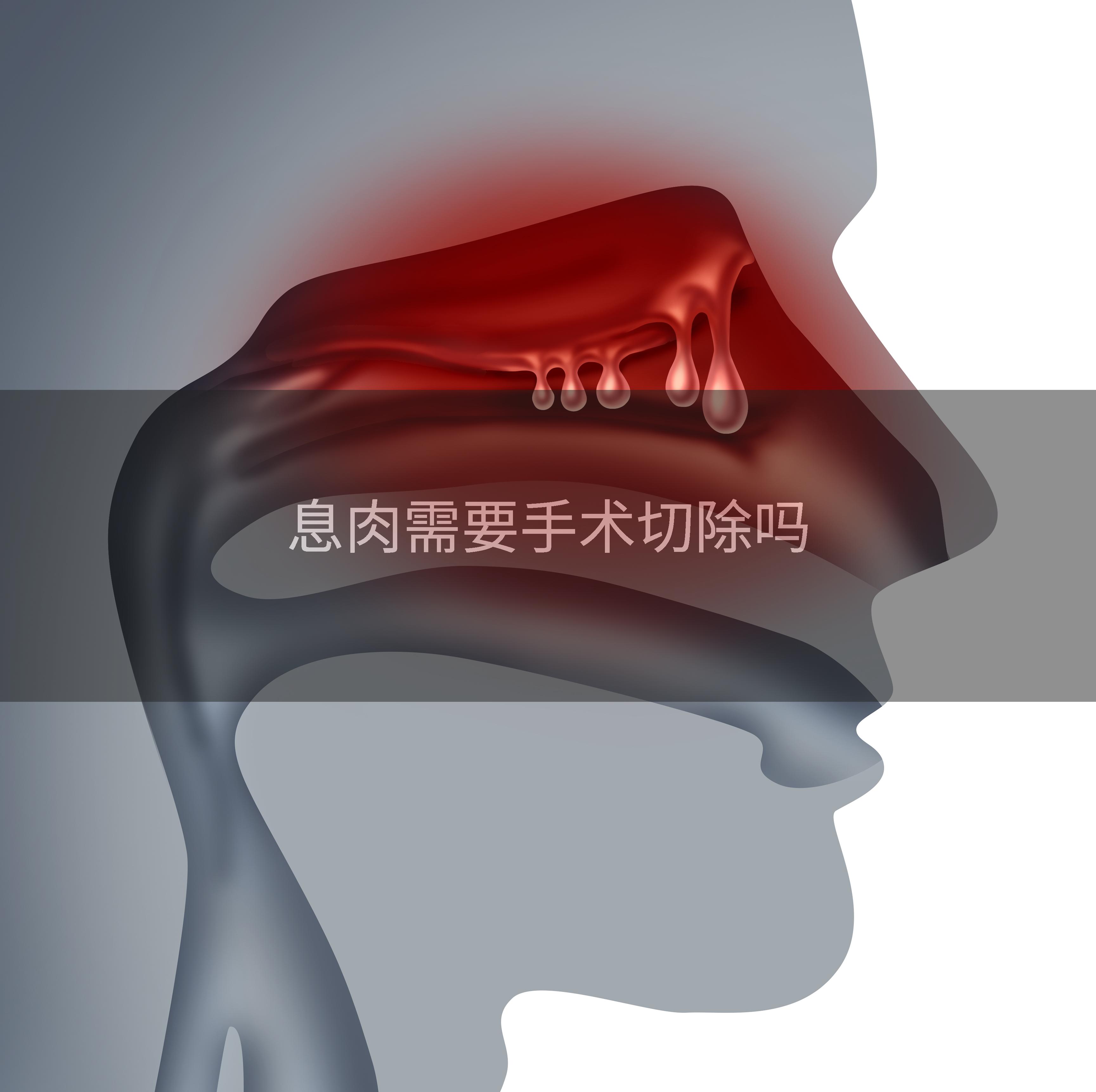 息肉需要手术切除吗