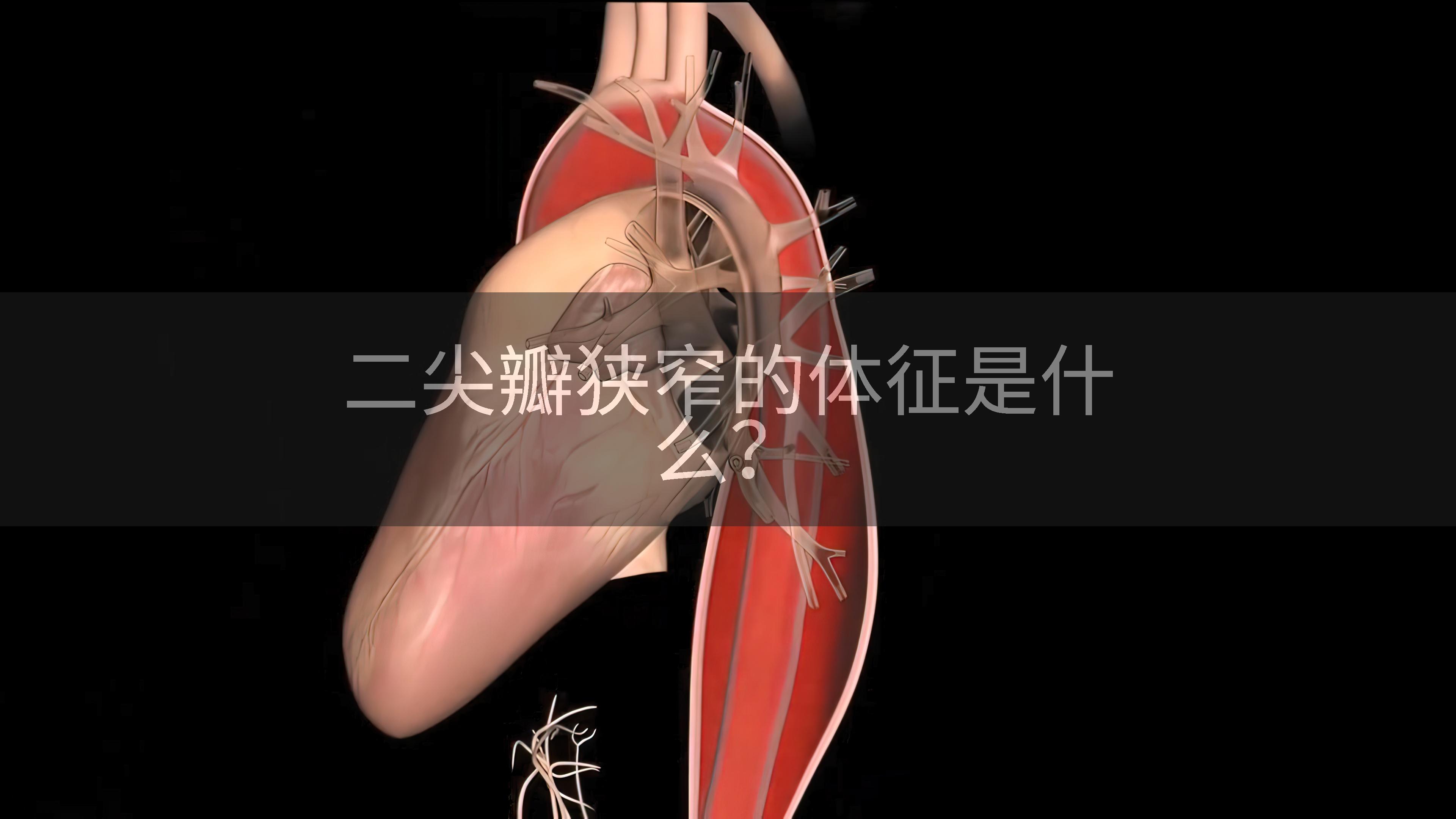 二尖瓣狭窄的体征是什么？