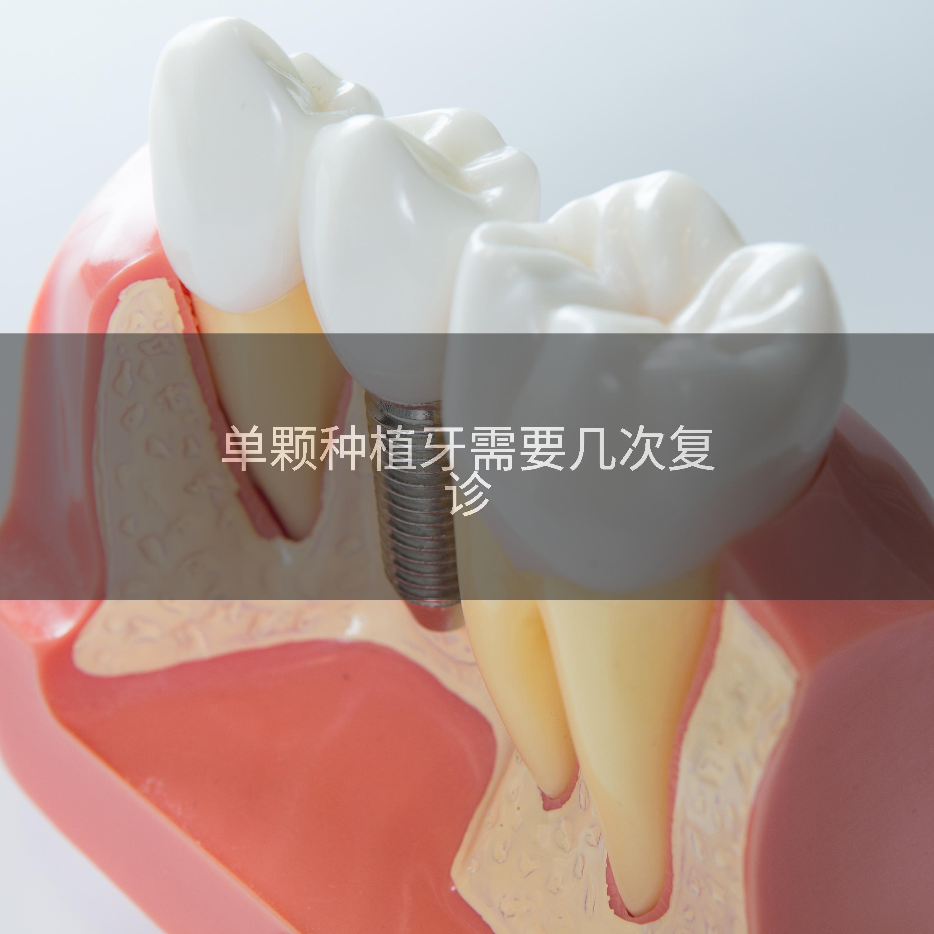 单颗种植牙需要几次复诊