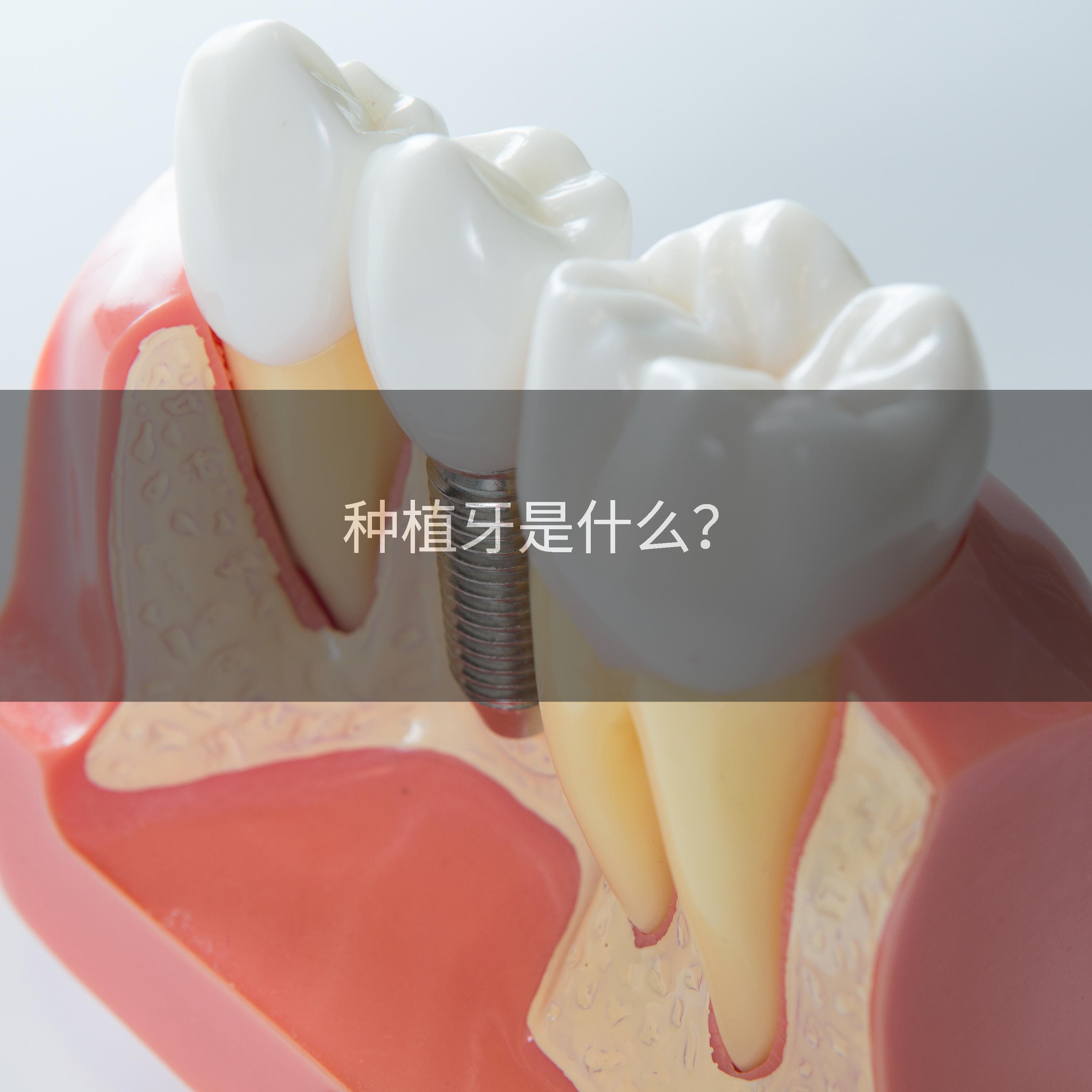 种植牙是什么？