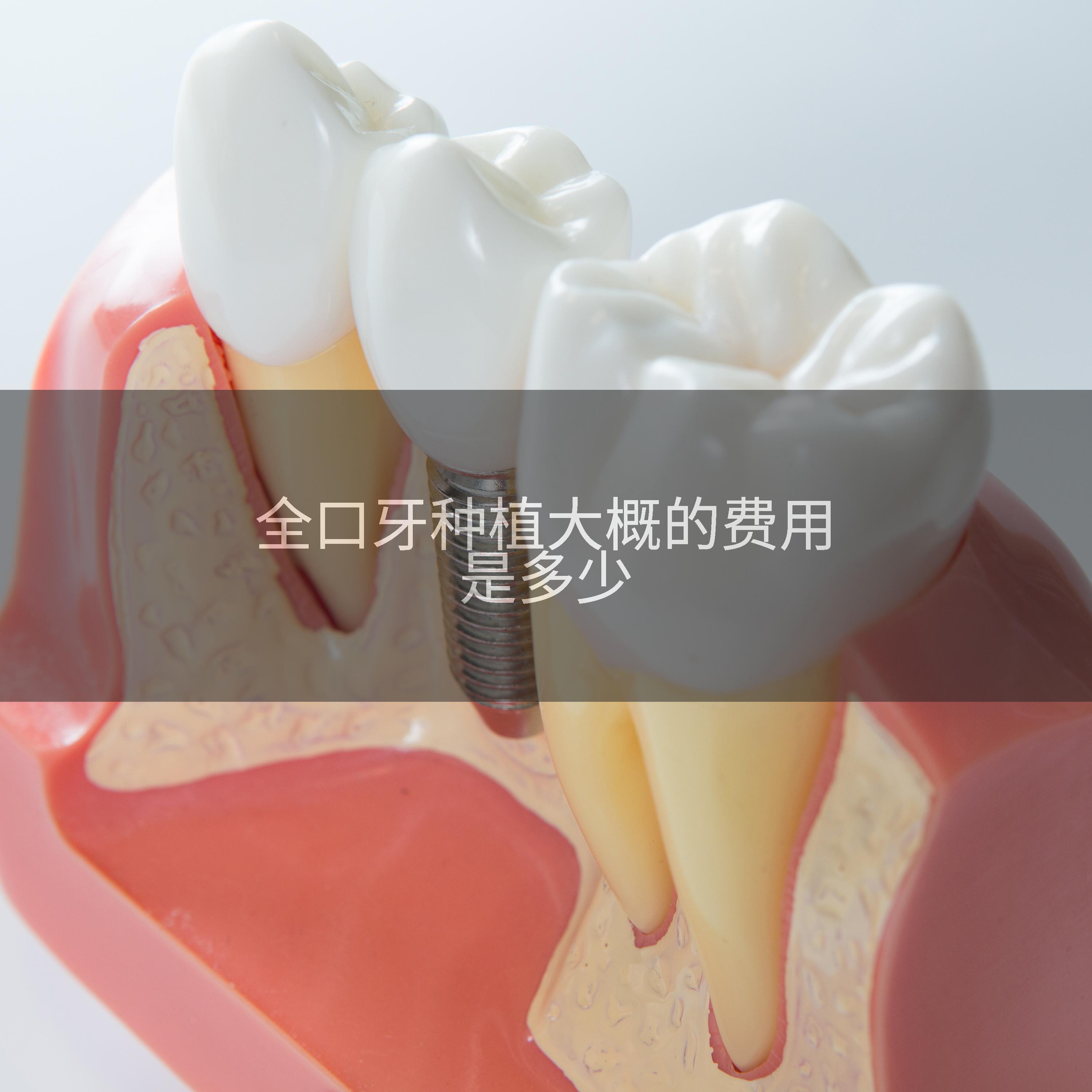 全口牙种植大概的费用是多少