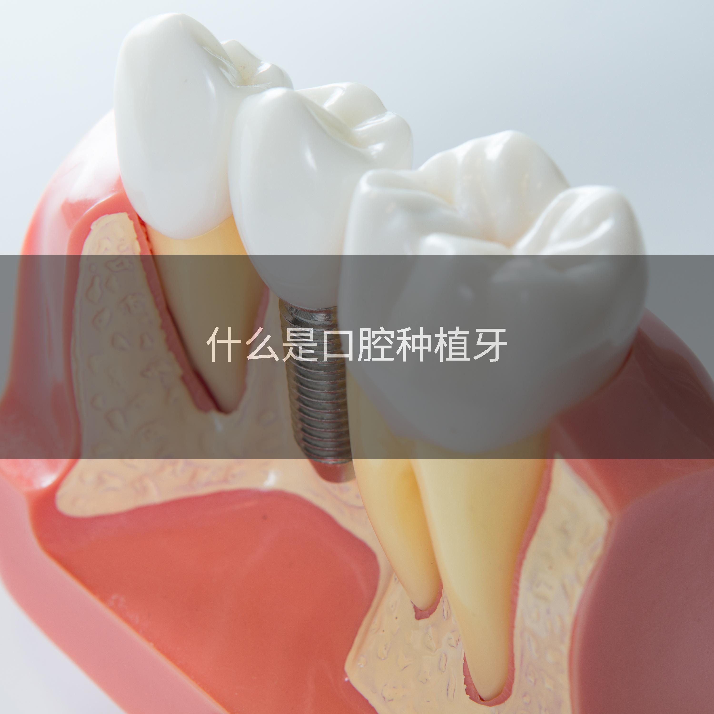 什么是口腔种植牙