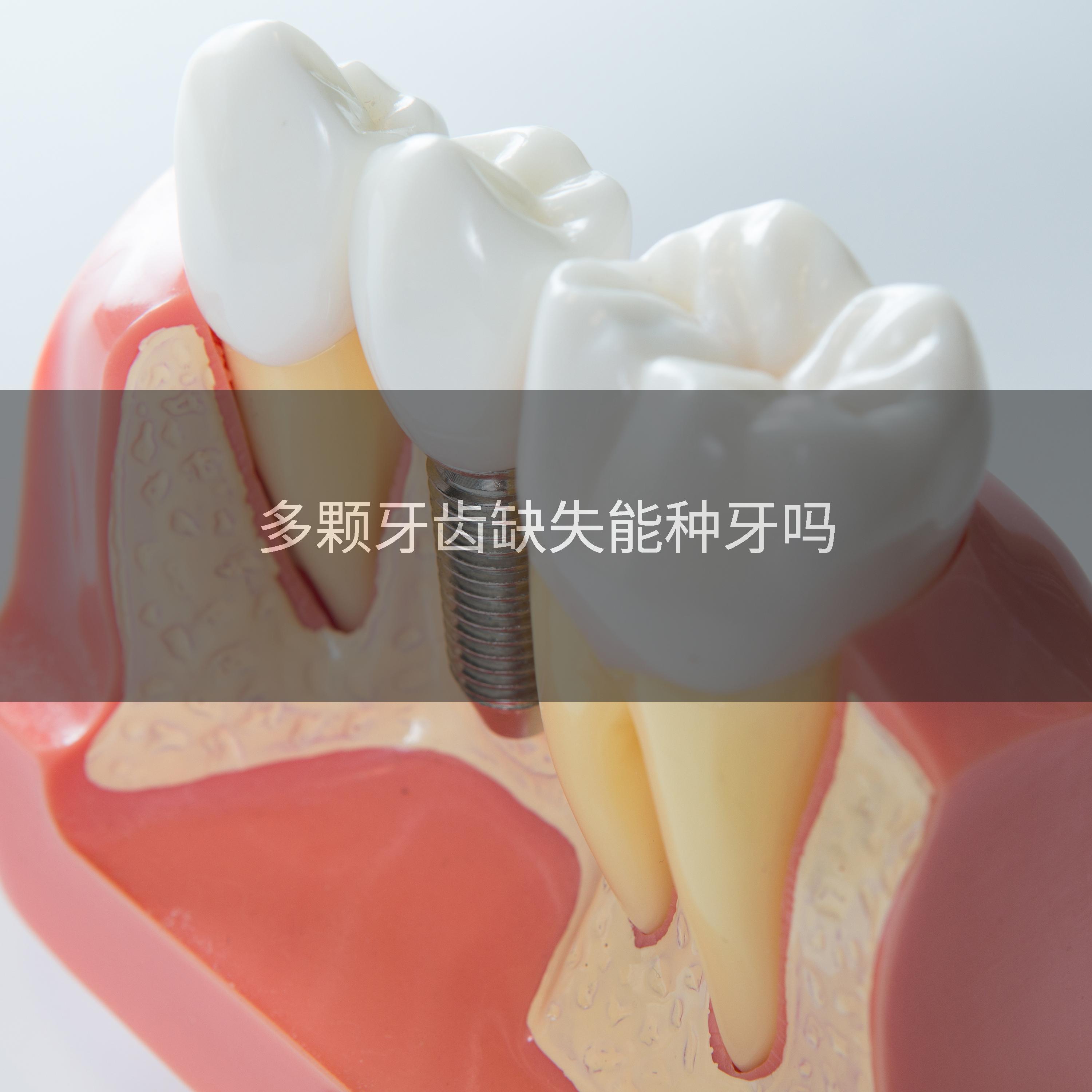 多颗牙齿缺失能种牙吗