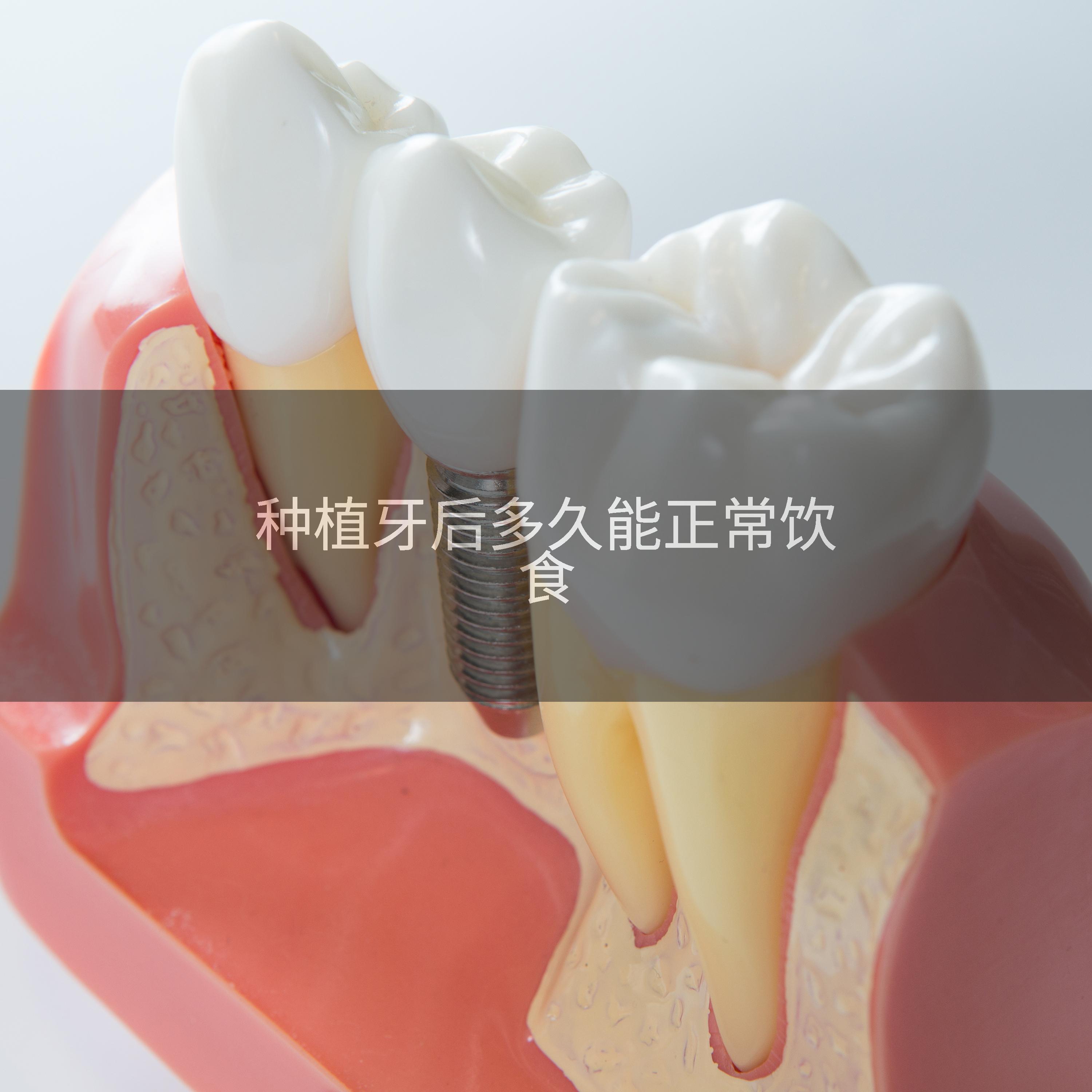 种植牙后多久能正常饮食