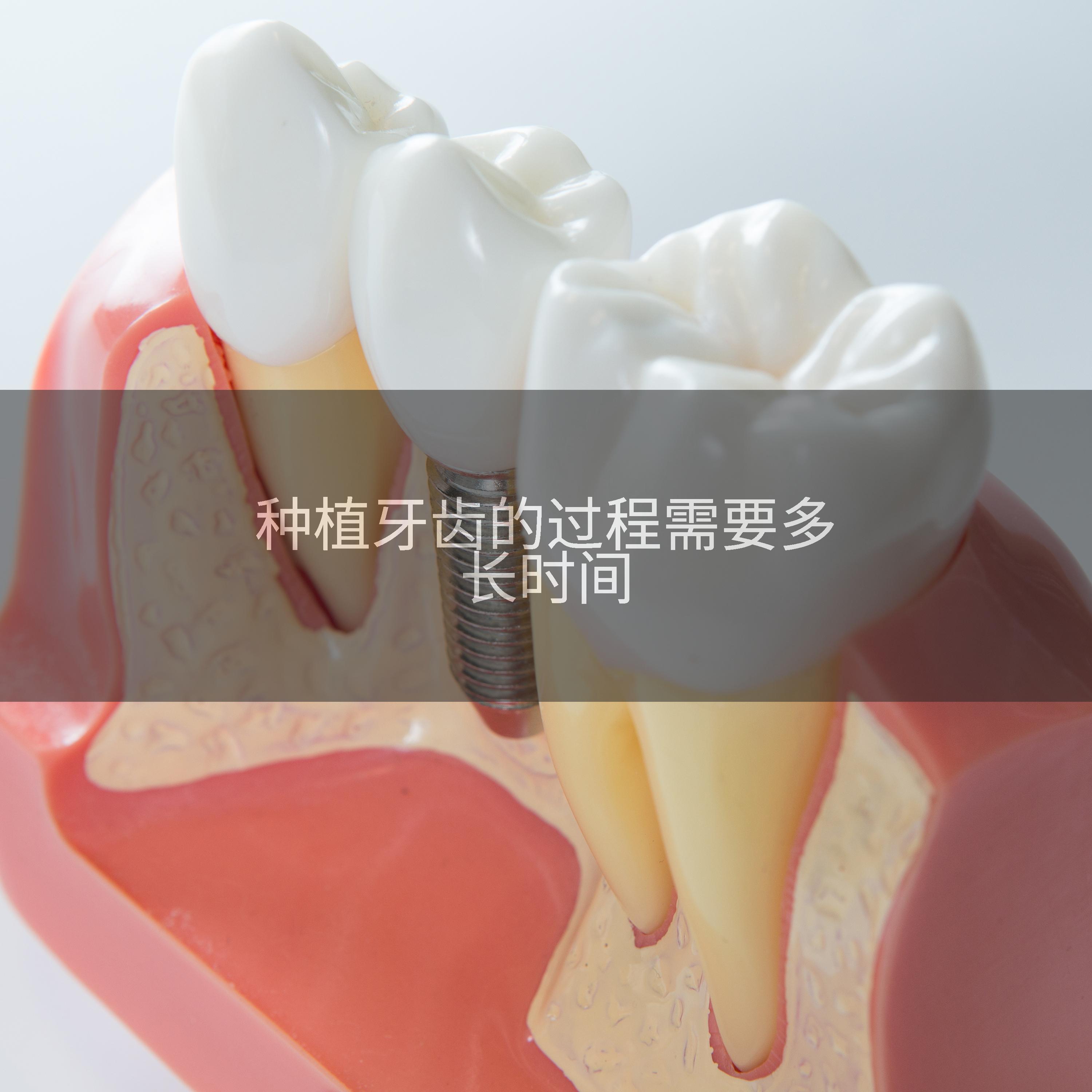 种植牙齿的过程需要多长时间
