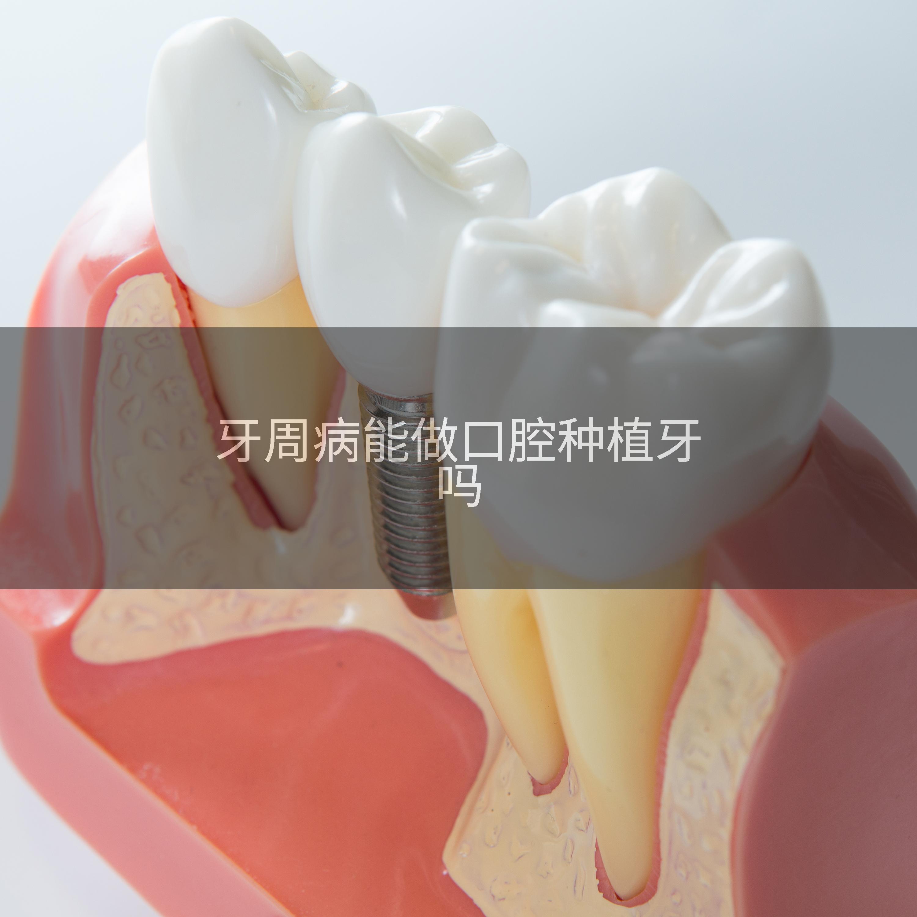 牙周病能做口腔种植牙吗