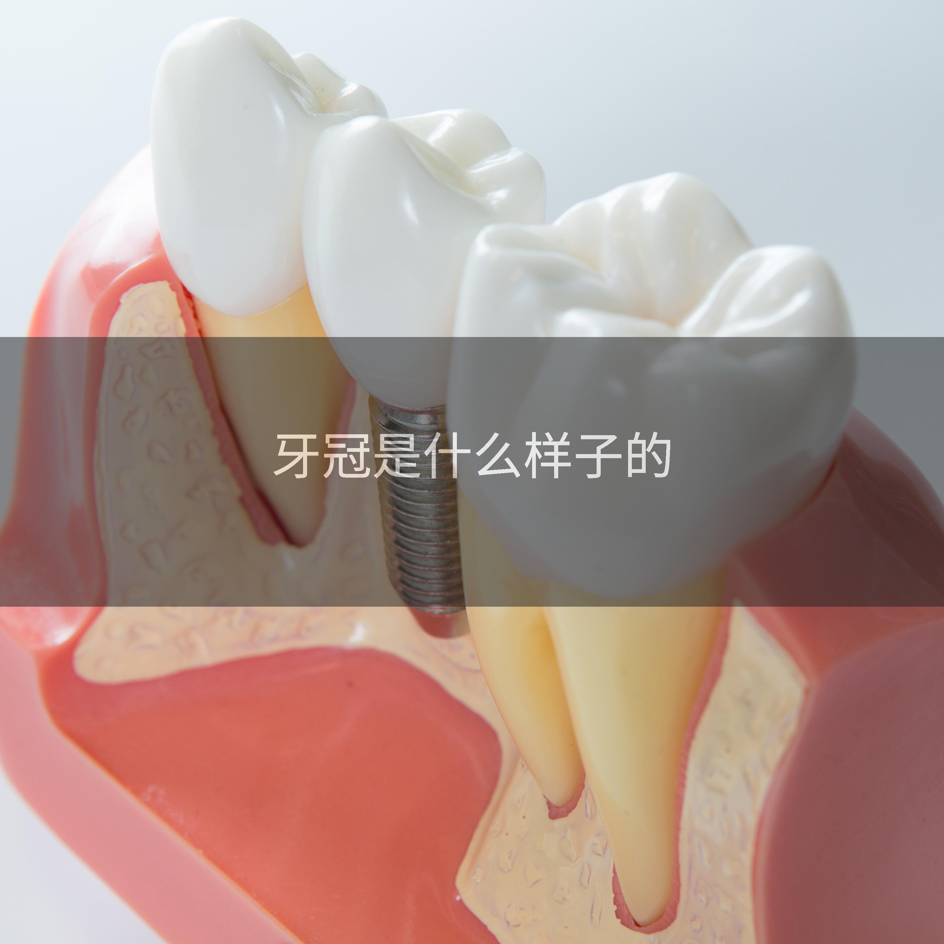 牙冠是什么样子的