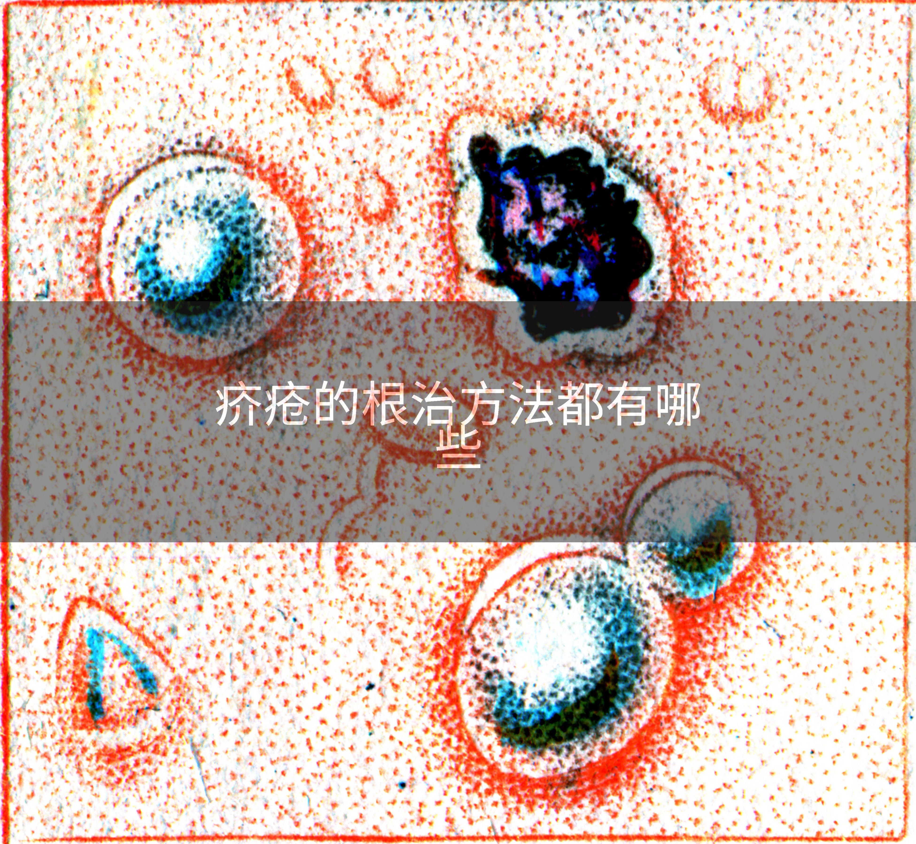 疥疮的根治方法都有哪些
