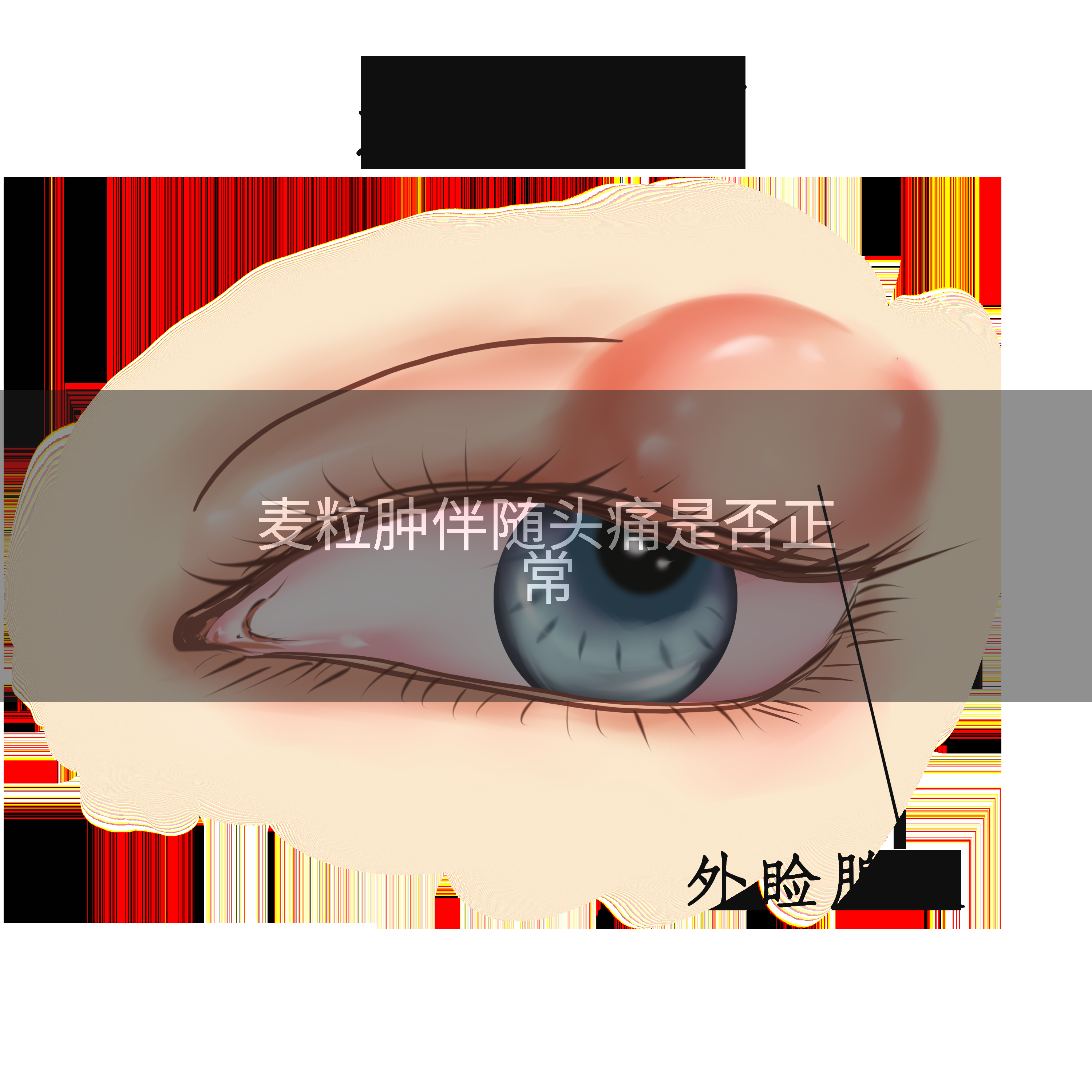 麦粒肿伴随头痛是否正常