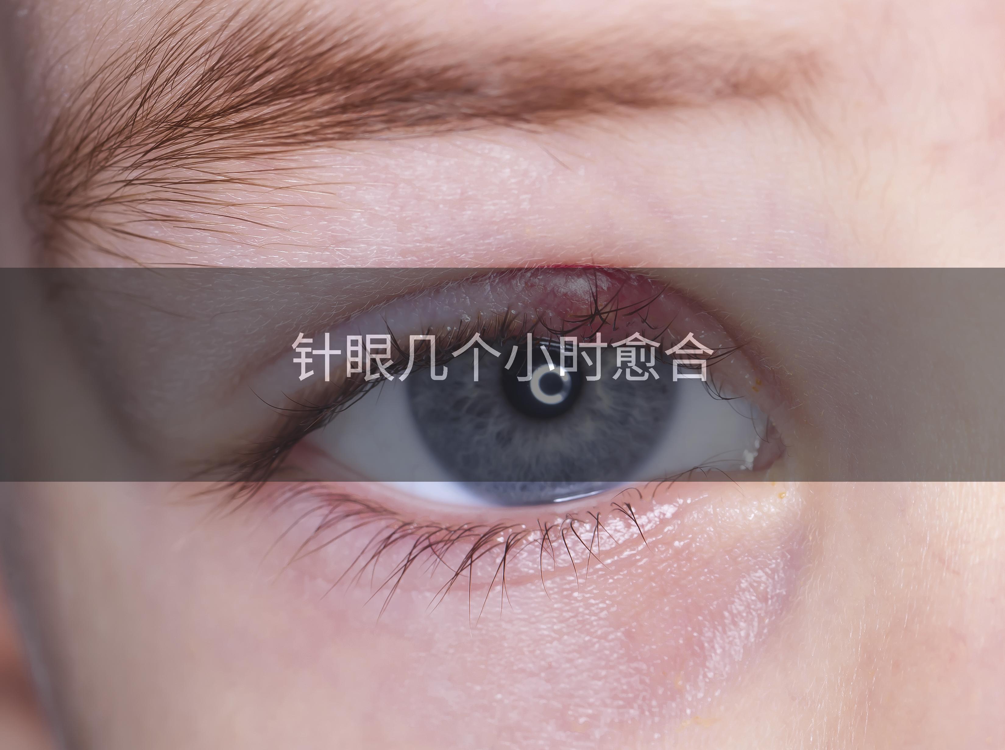 针眼几个小时愈合