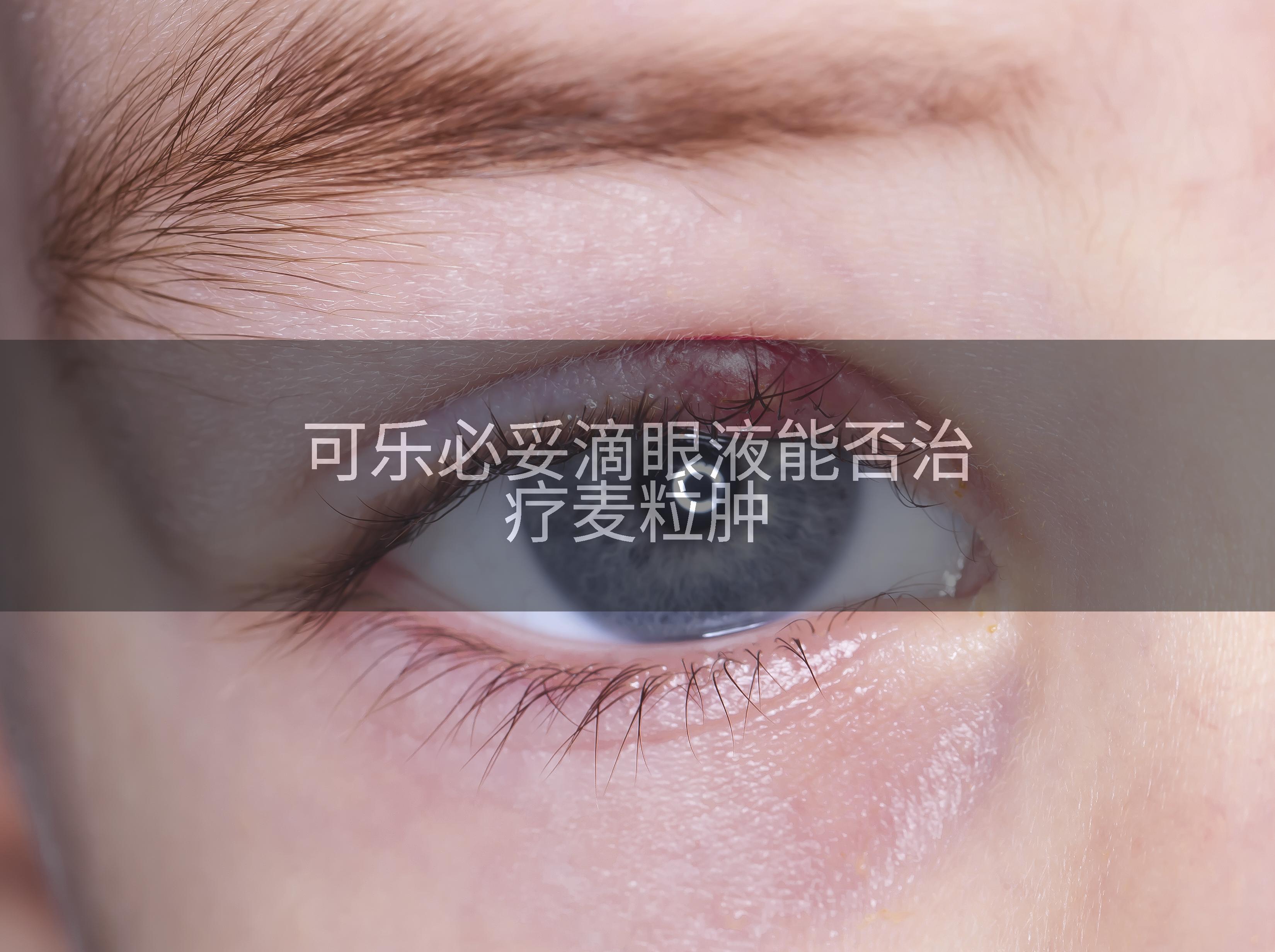 可乐必妥滴眼液能否治疗麦粒肿