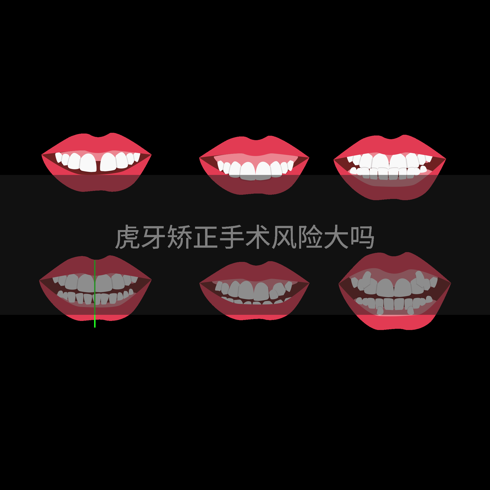 虎牙矫正手术风险大吗