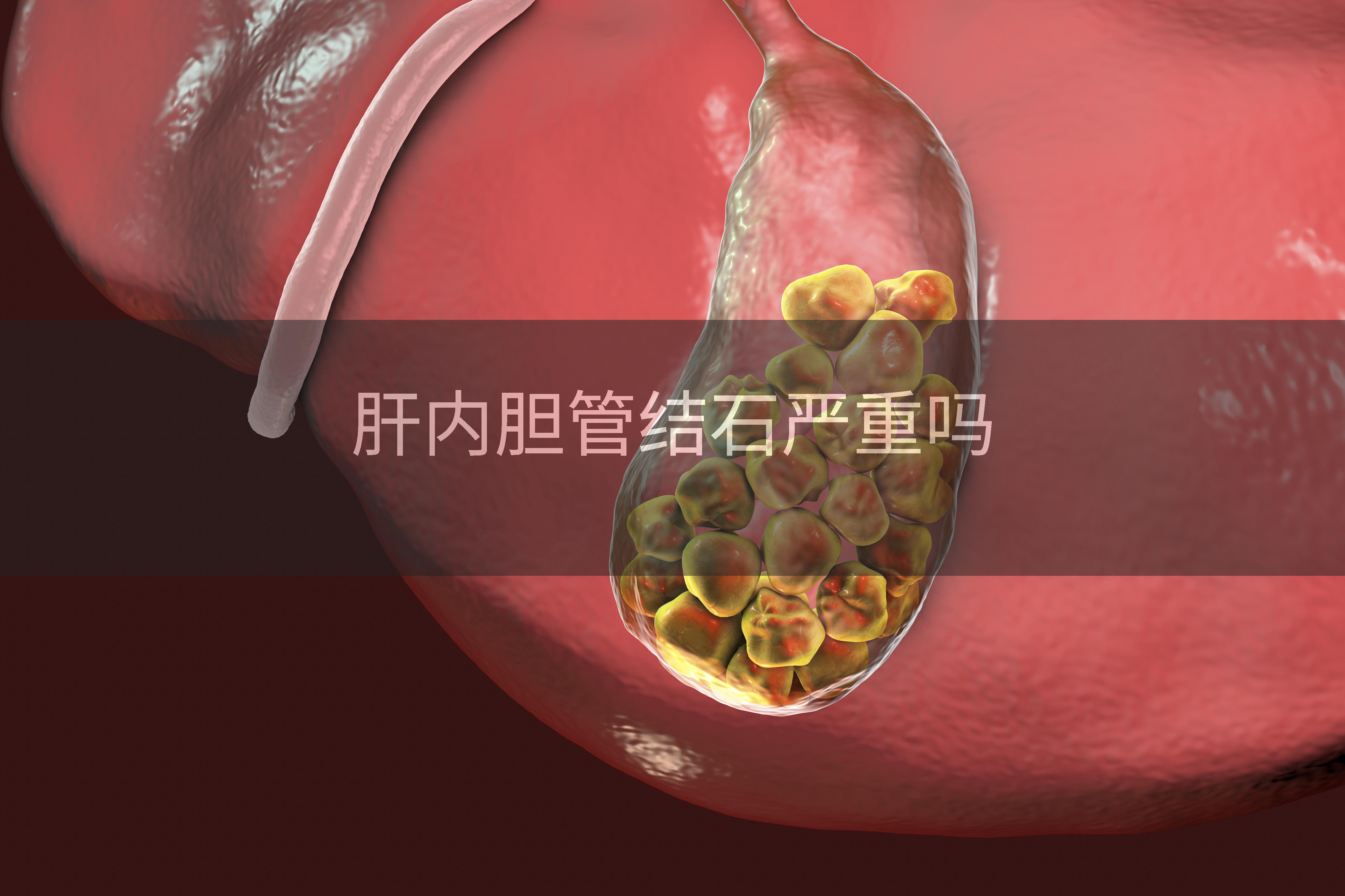 肝内胆管结石严重吗